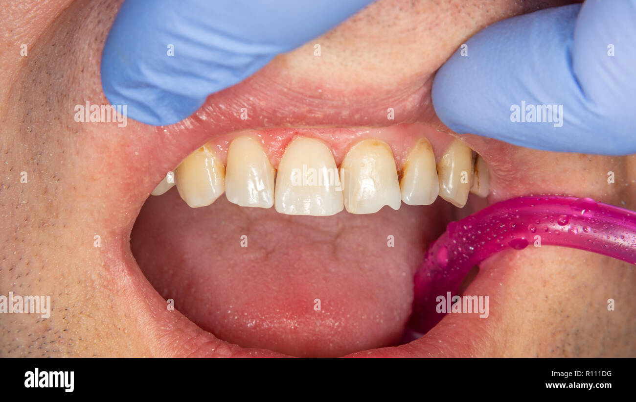 Dental caries. Filling with dental composite photopolymer material