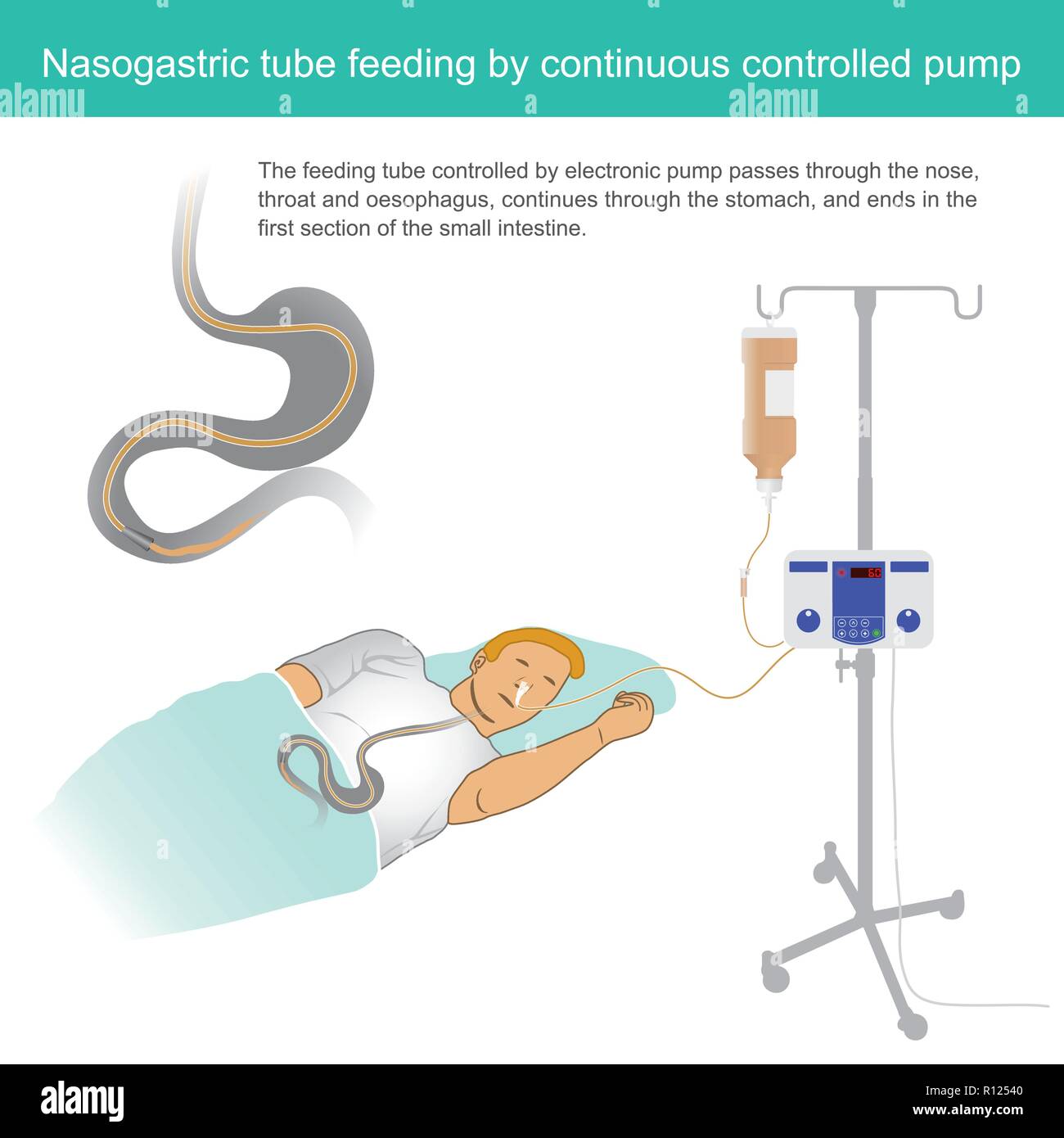 The feeding tube controlled by electronic pump passes through the nose, throat and oesophagus, continues through the stomach, and ends in the first se Stock Vector