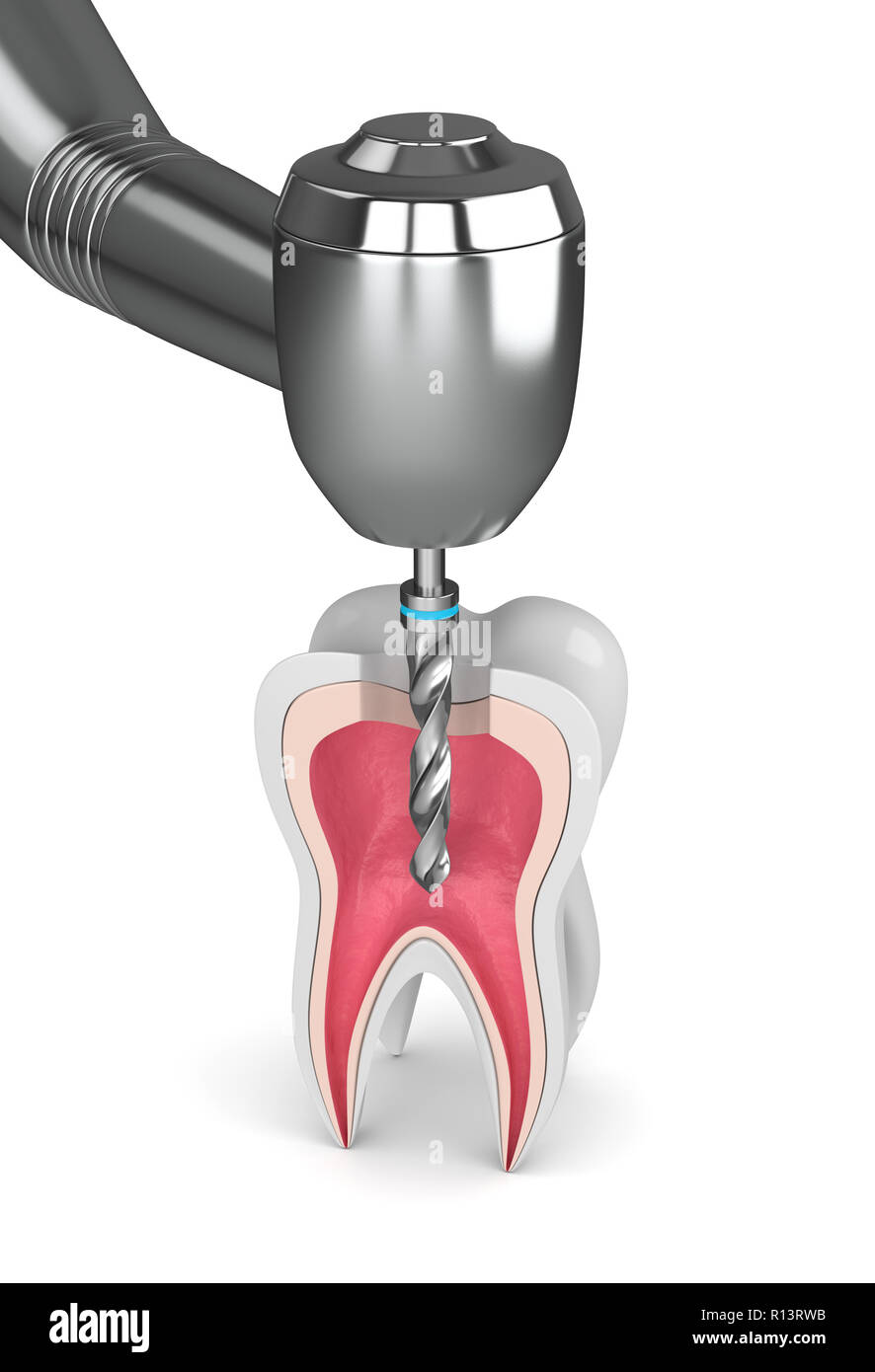 3d Render Of Tooth With Dental Drill Over White Background Stock