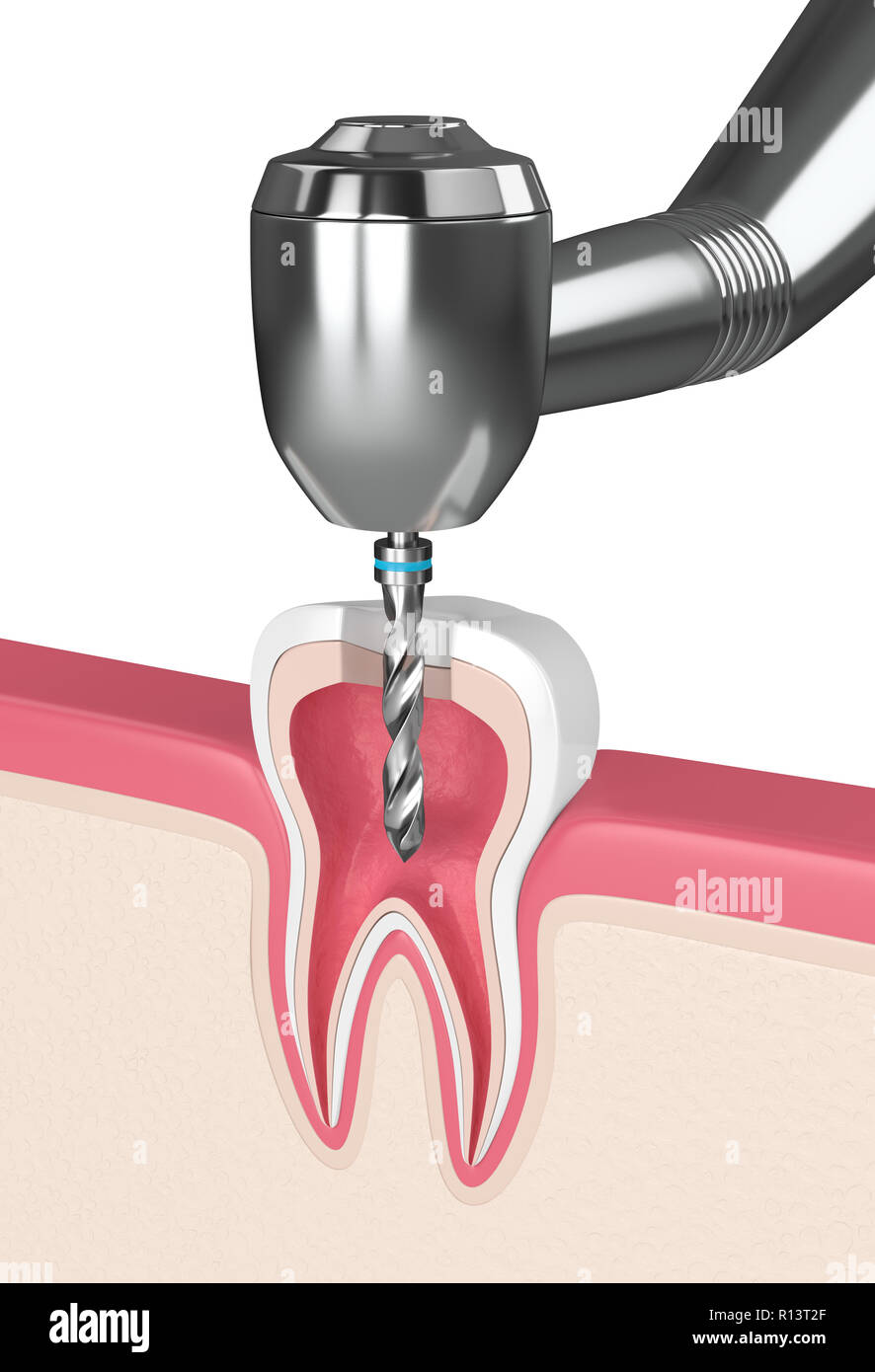 3d render of tooth in gums with dental drill Stock Photo Alamy