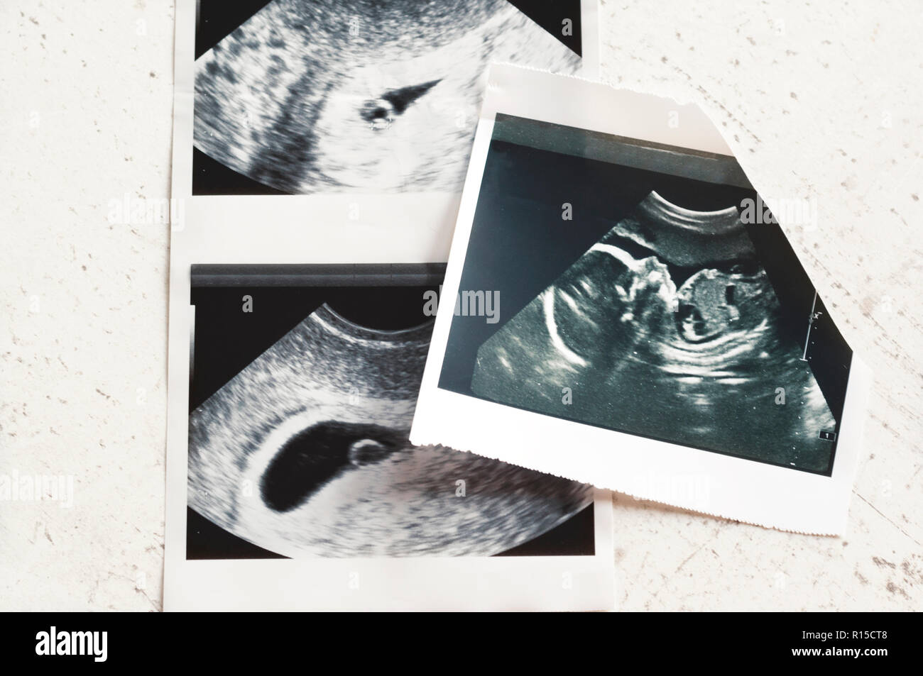Photographs Of Ultrasound Of Pregnancy At 4 Weeks And 20 Weeks Of