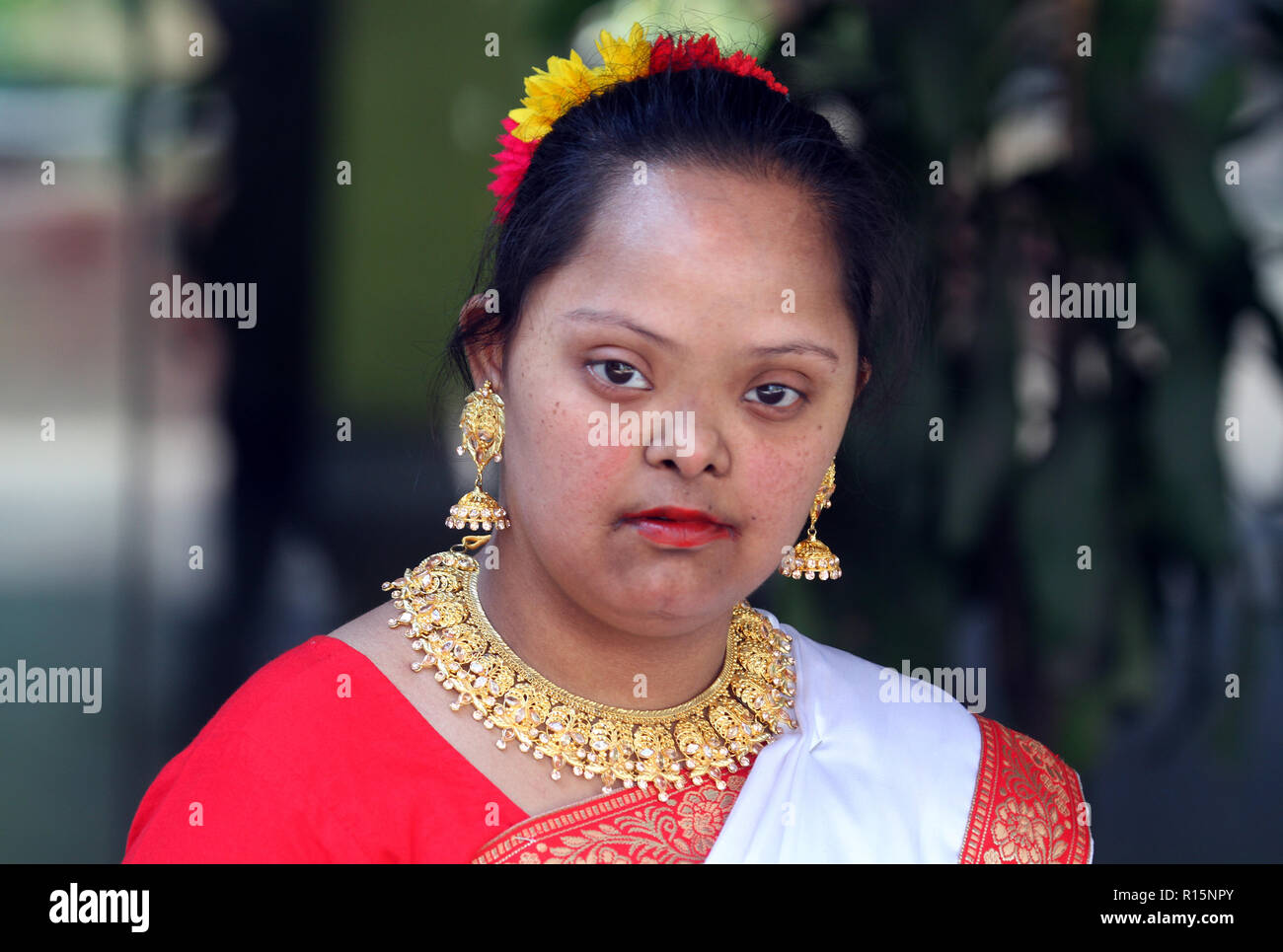 Dhaka, Bangladesh March 21, 2015 Bangladeshi Down syndrome girl at