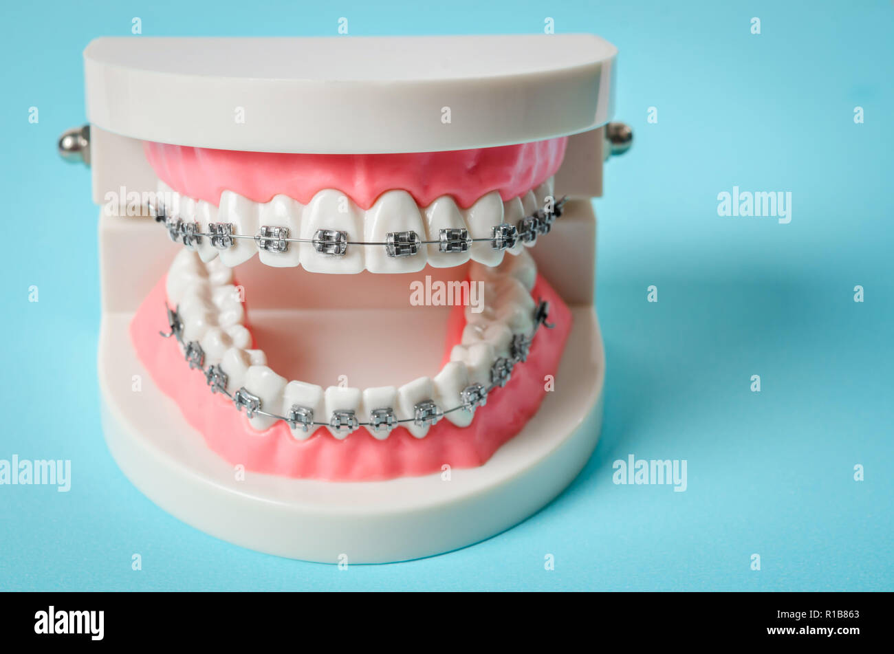 tooth model with metal wire dental braces on blue background Stock ...