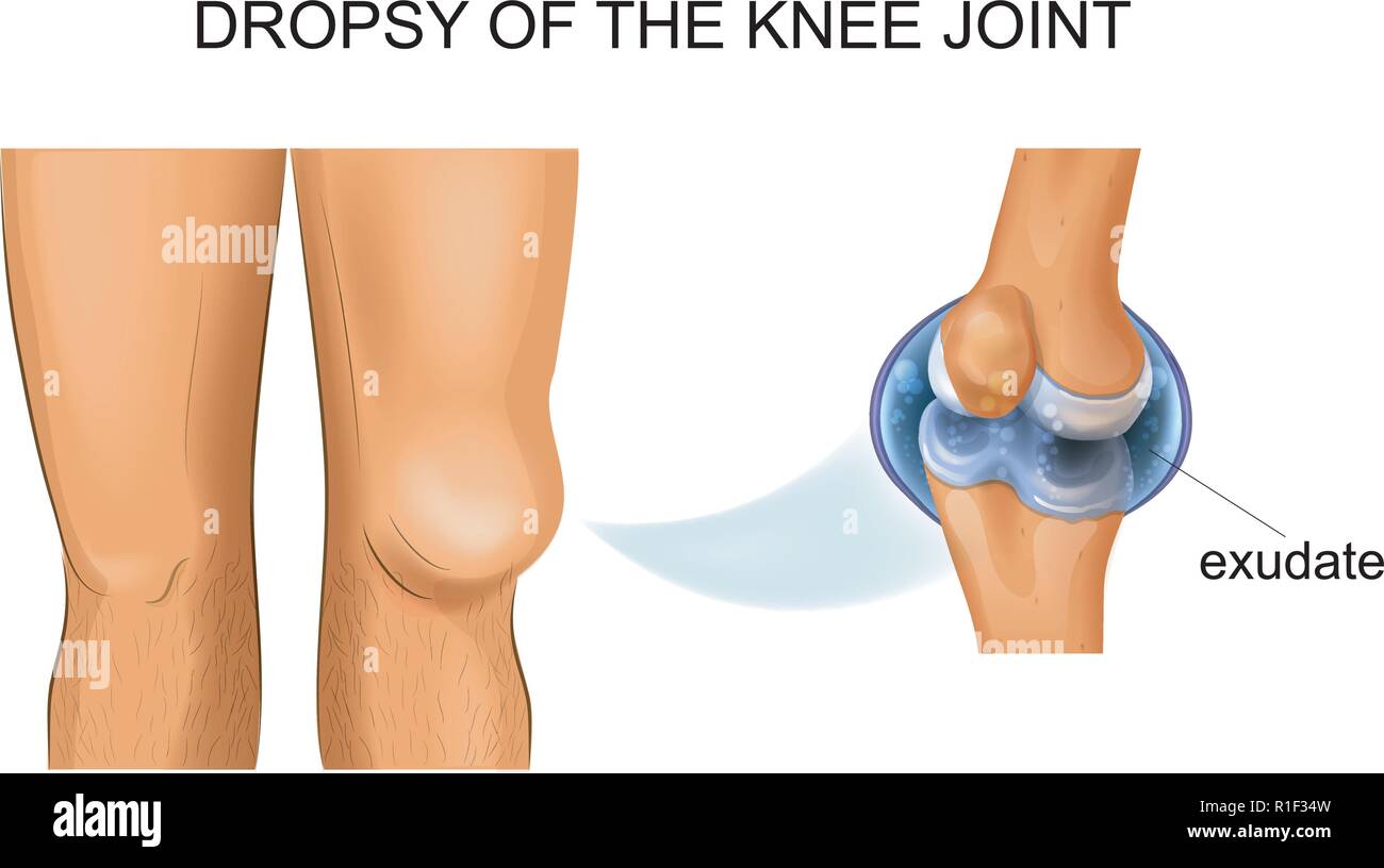 vector illustration of knee hydrarthrosis, articular dropsy Stock Vector