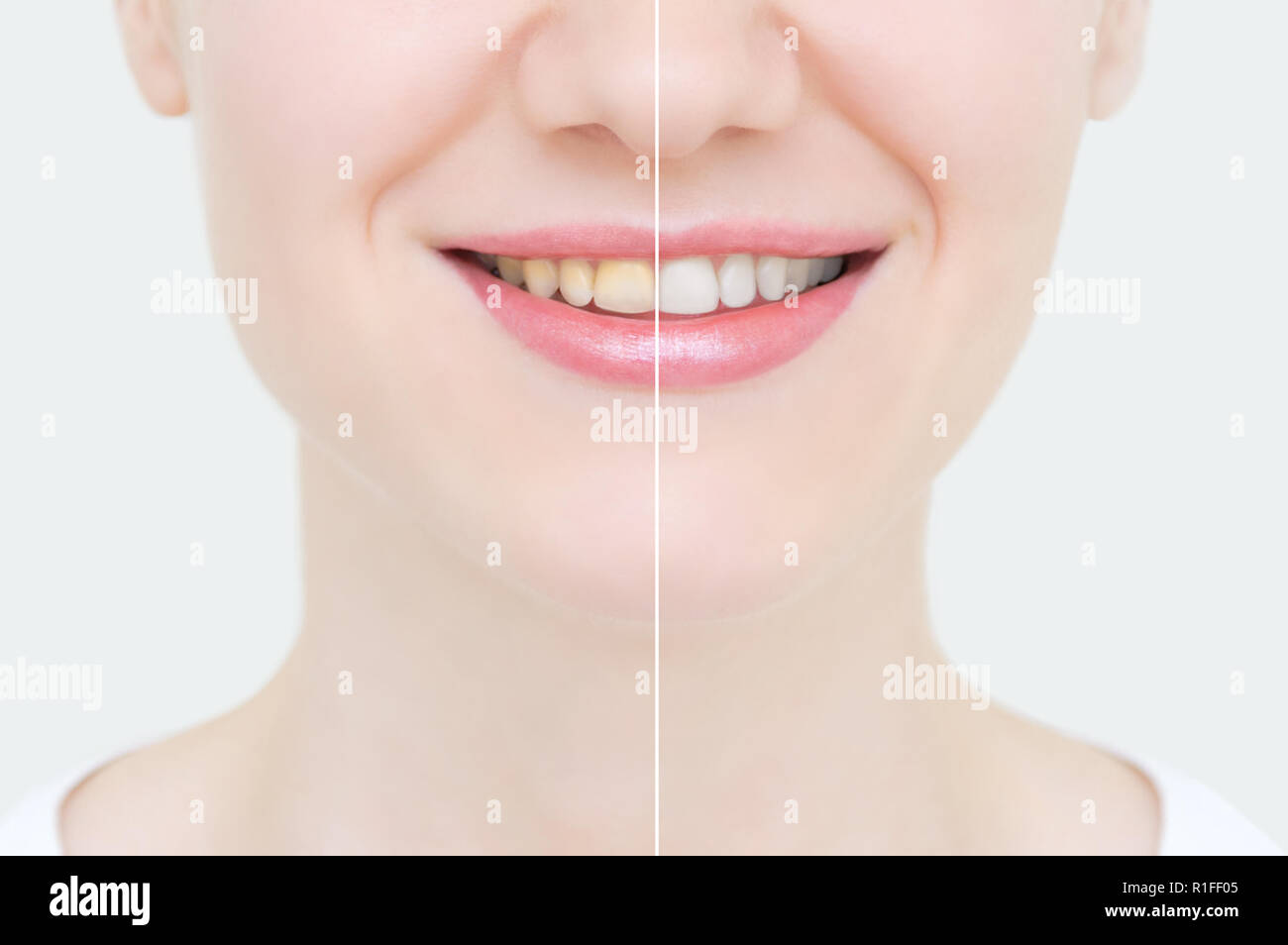 Perfect smile before and after bleaching. Dental care and whitening teeth.Face close-up. Stock Photo