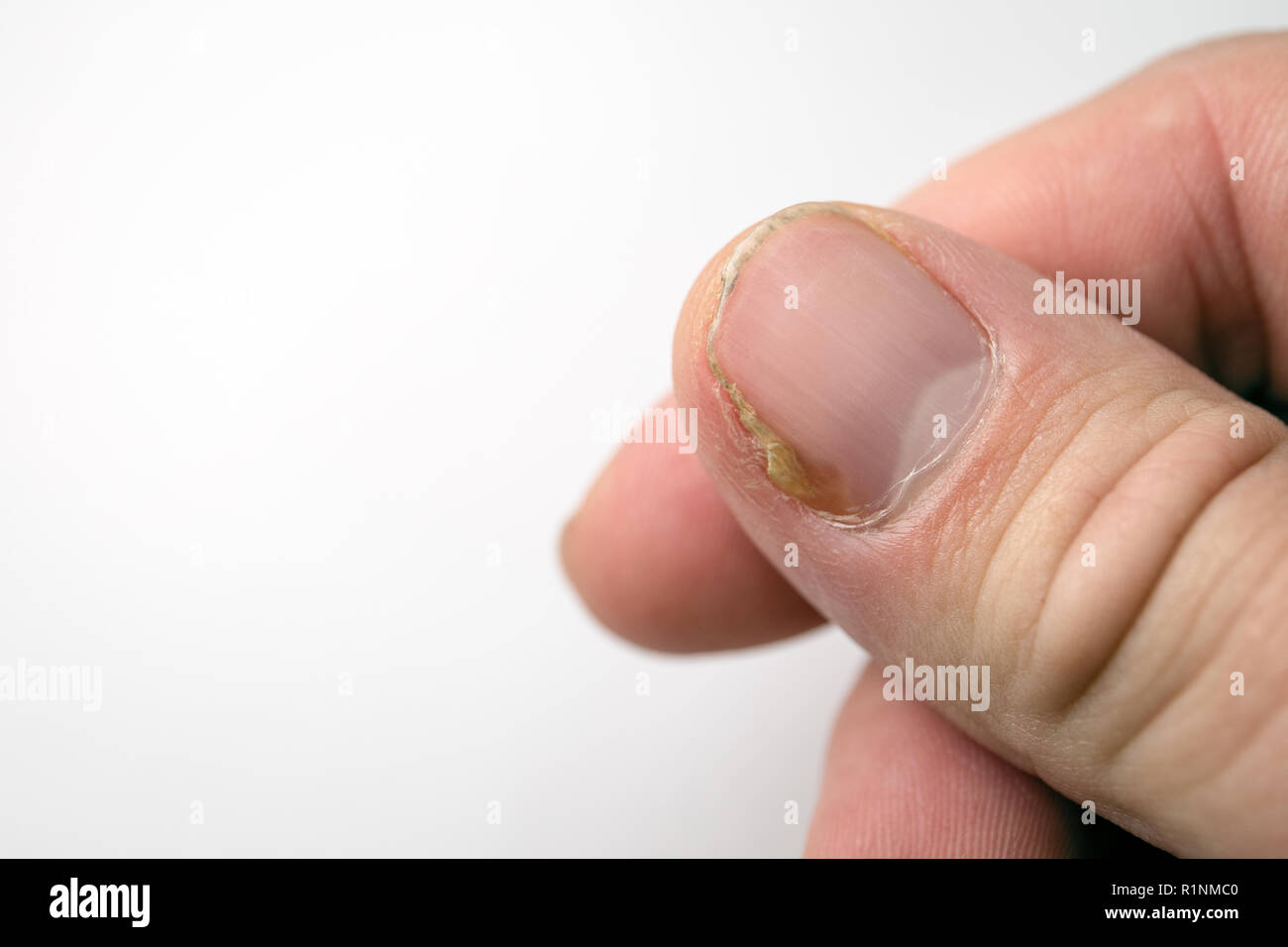 Nail Disease High Resolution Stock Photography and Images Alamy
