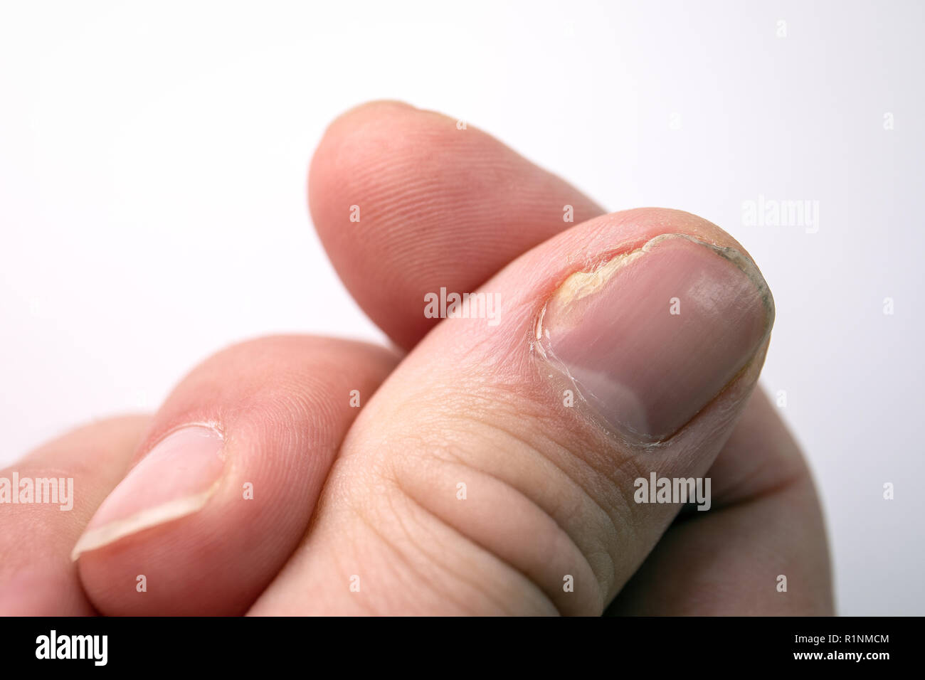 fungal infection. nail fungus candida on hand fingernail Stock Photo |  Adobe Stock