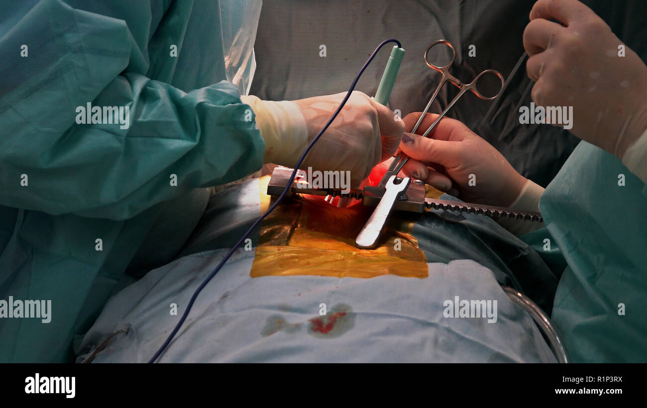 Suture of an lung emphysema surgery in an infant, medical assistance close-up Stock Photo