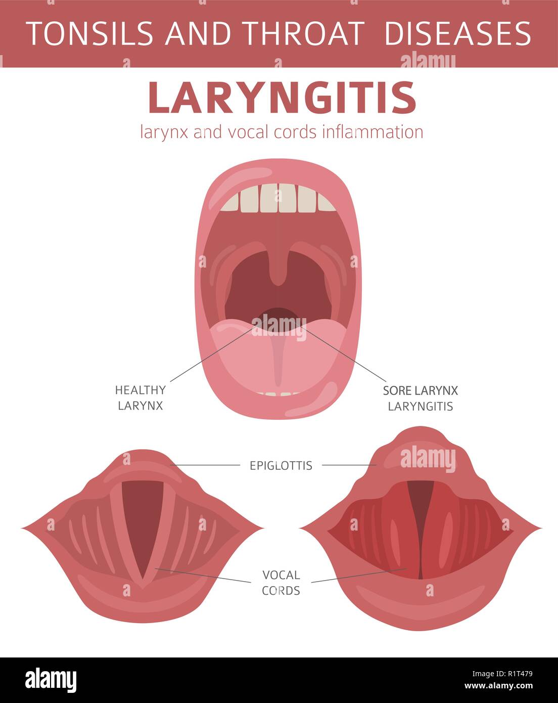 Tonsils and throat diseases. Laryngitis symptoms, treatment icon set