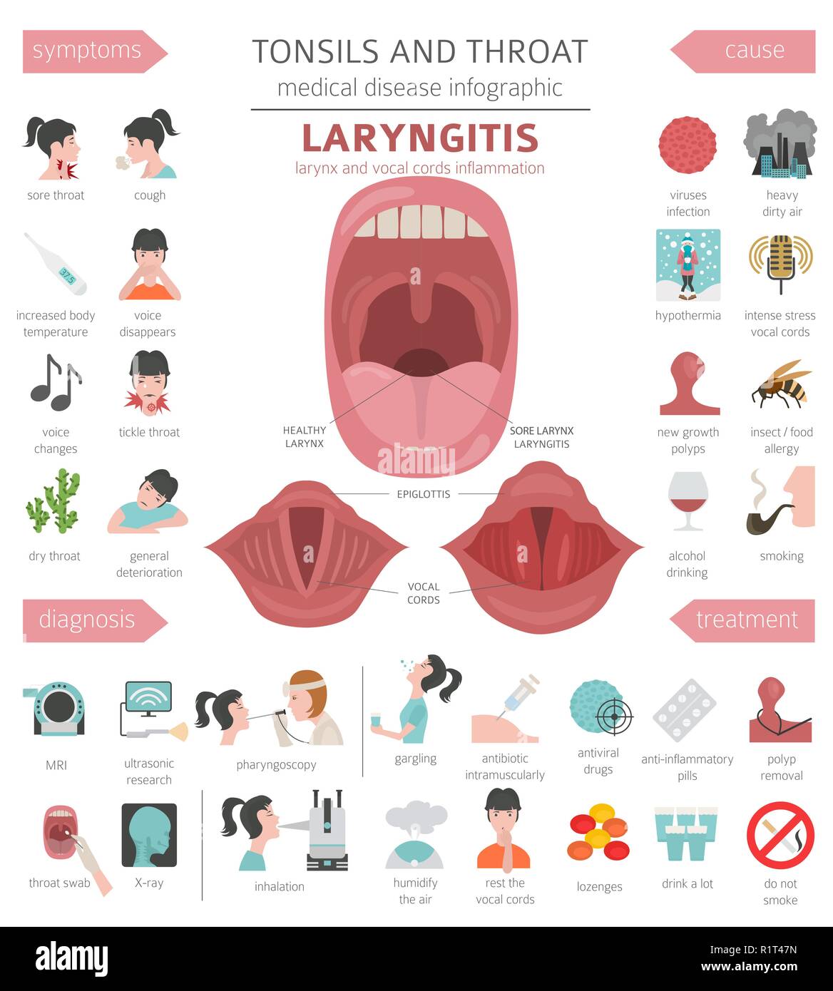 Tonsils and throat diseases. Laryngitis symptoms, treatment icon set.  Medical infographic design. Vector illustration Stock Vector Image & Art -  Alamy