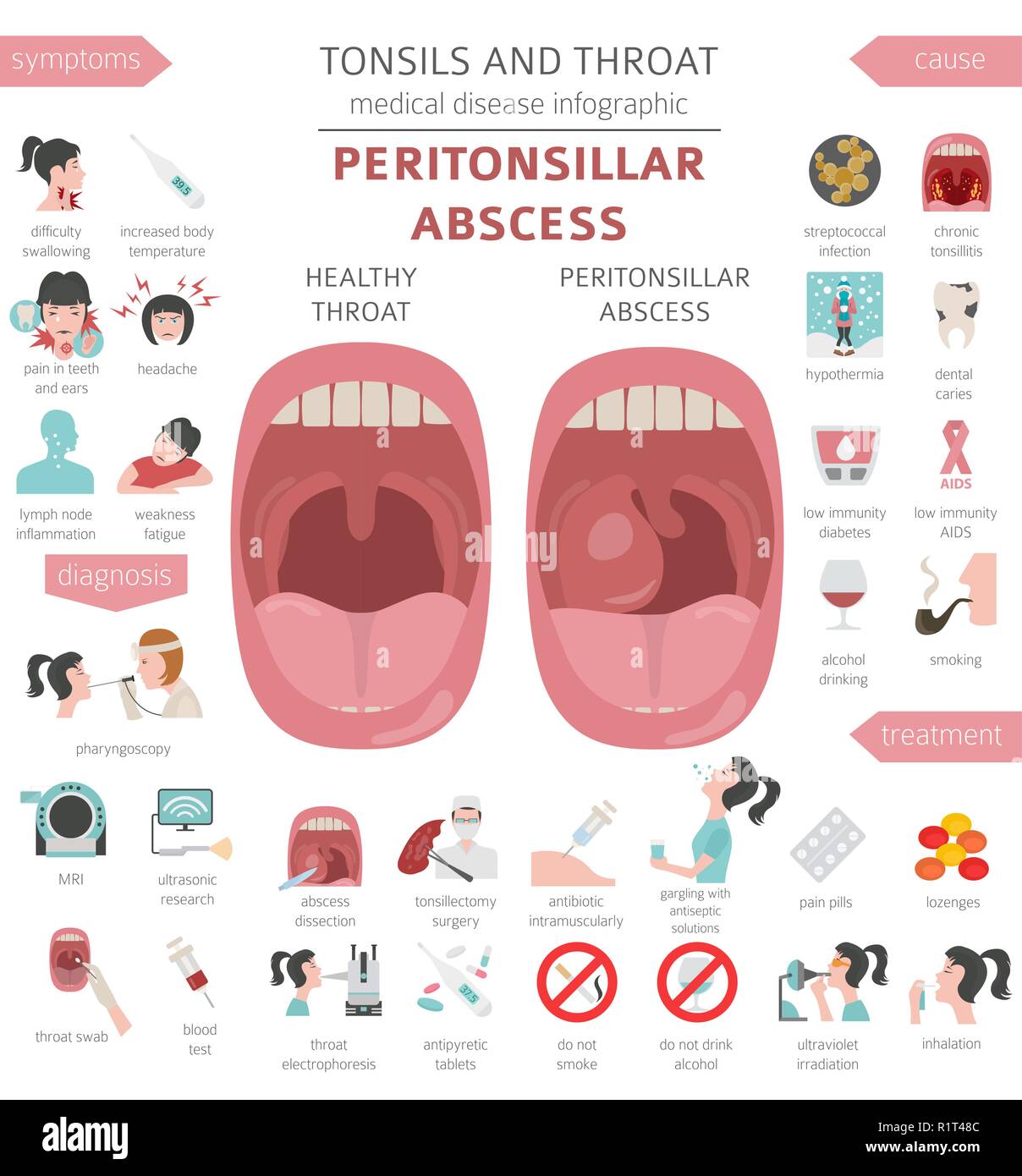 Tonsils and throat diseases. Peritonsillar abscess symptoms, treatment icon set. Medical infographic design. Vector illustration Stock Vector
