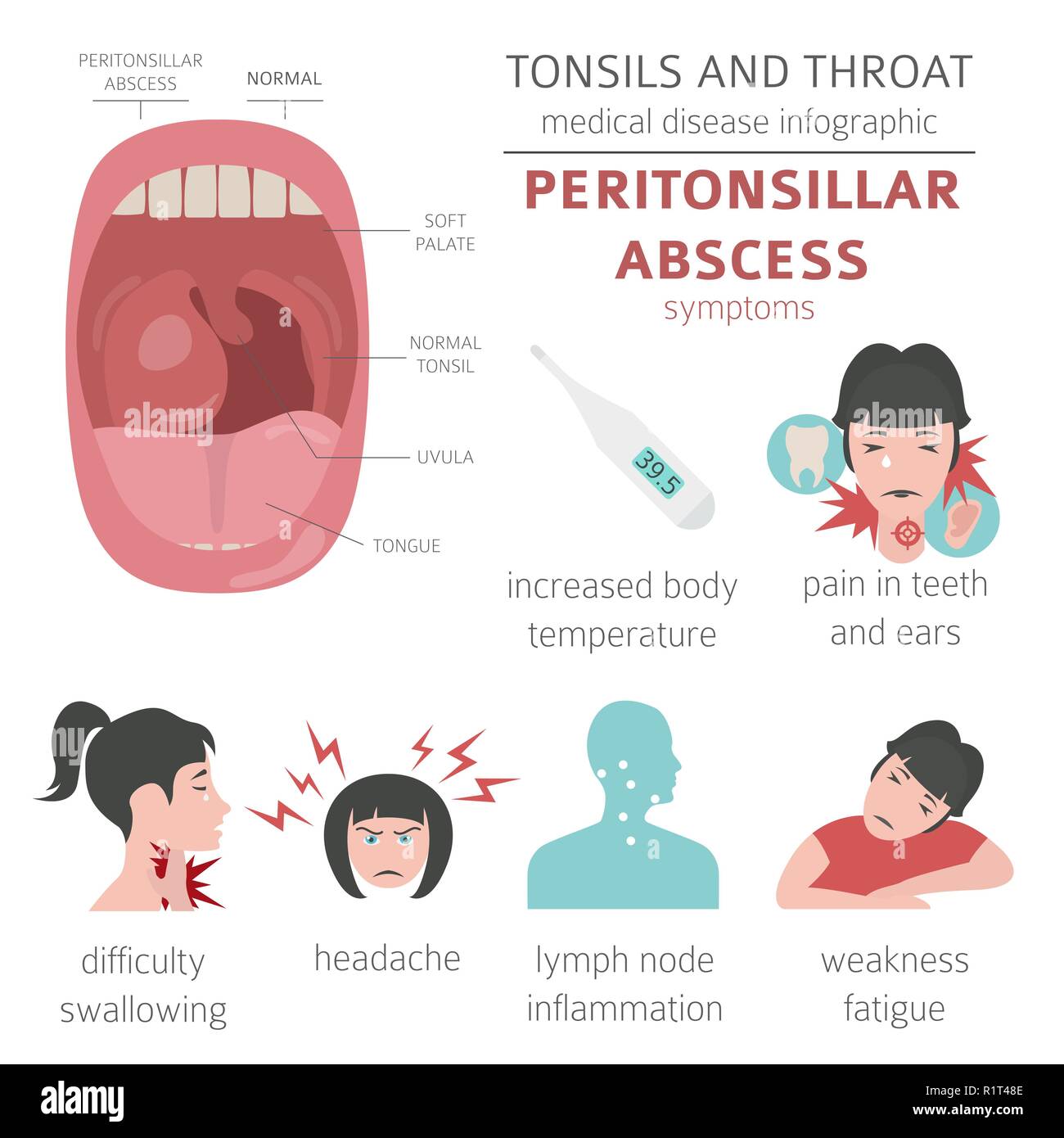Tonsils and throat diseases. Peritonsillar abscess symptoms, treatment icon set. Medical infographic design. Vector illustration Stock Vector