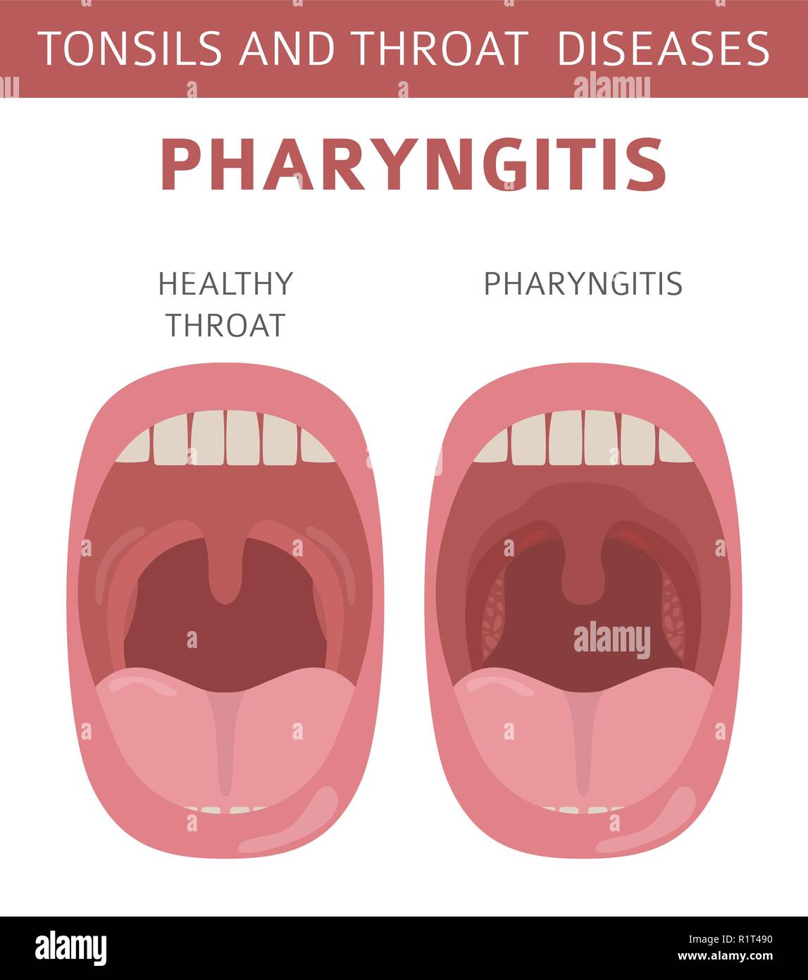 Tonsils And Throat Diseases Pharyngitis Symptoms Treatment Icon Set