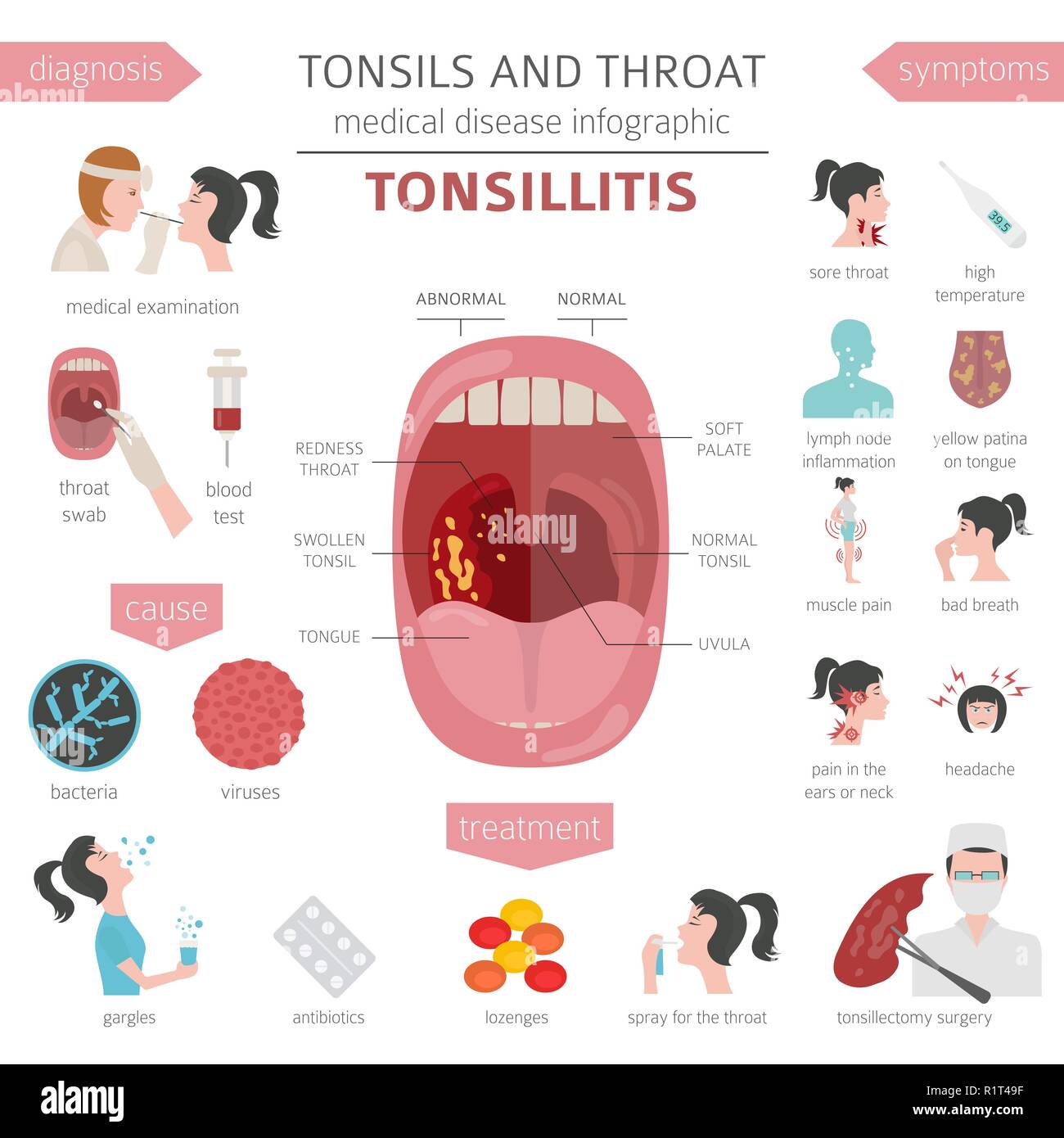 Tonsillitis Treatment
