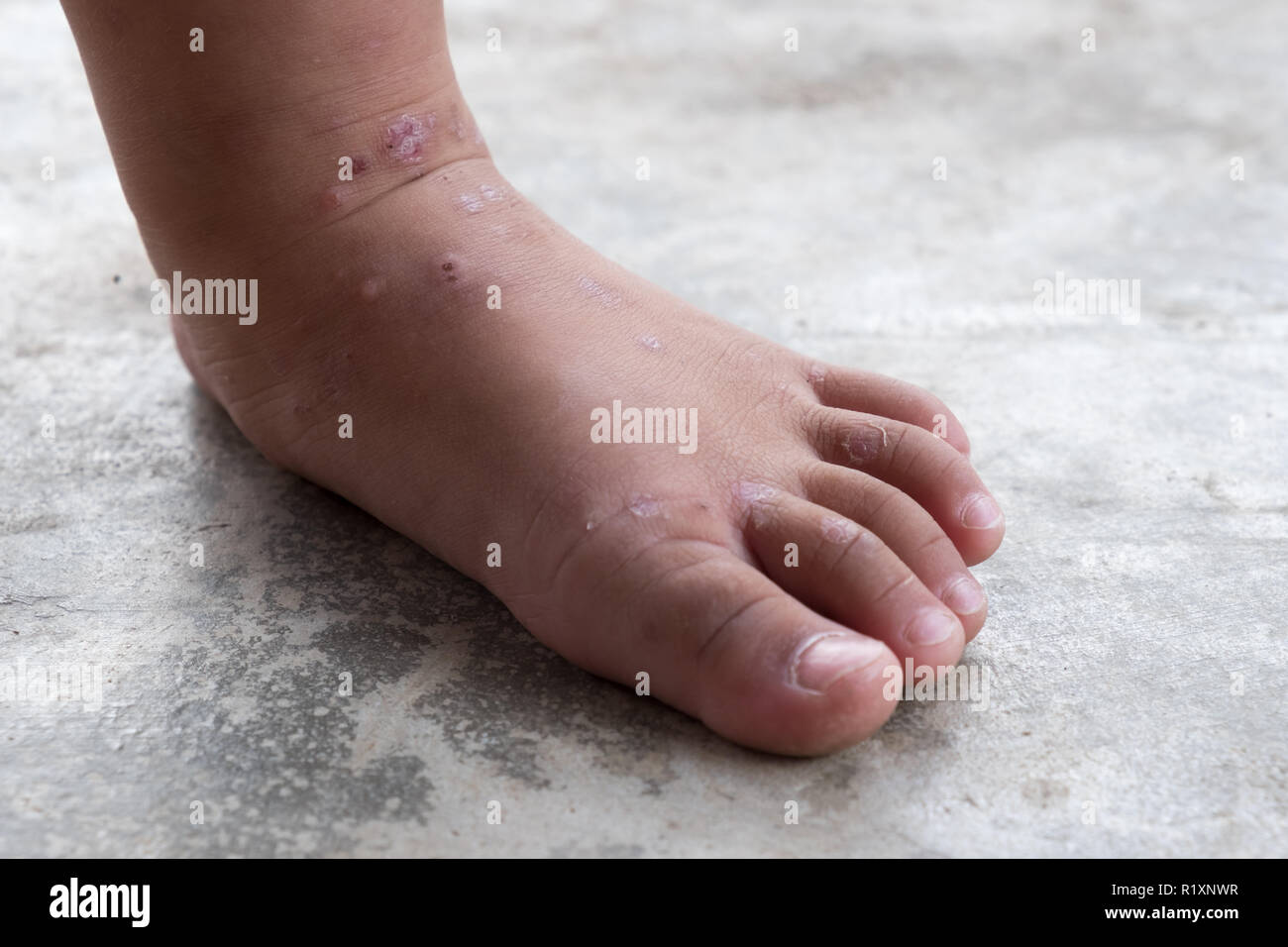 Painful foot children hires stock photography and images Alamy