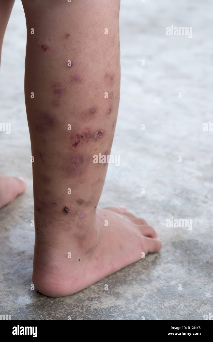 Itchy dermatitis atopic baby foot. Close up Infected wound.Opened wound