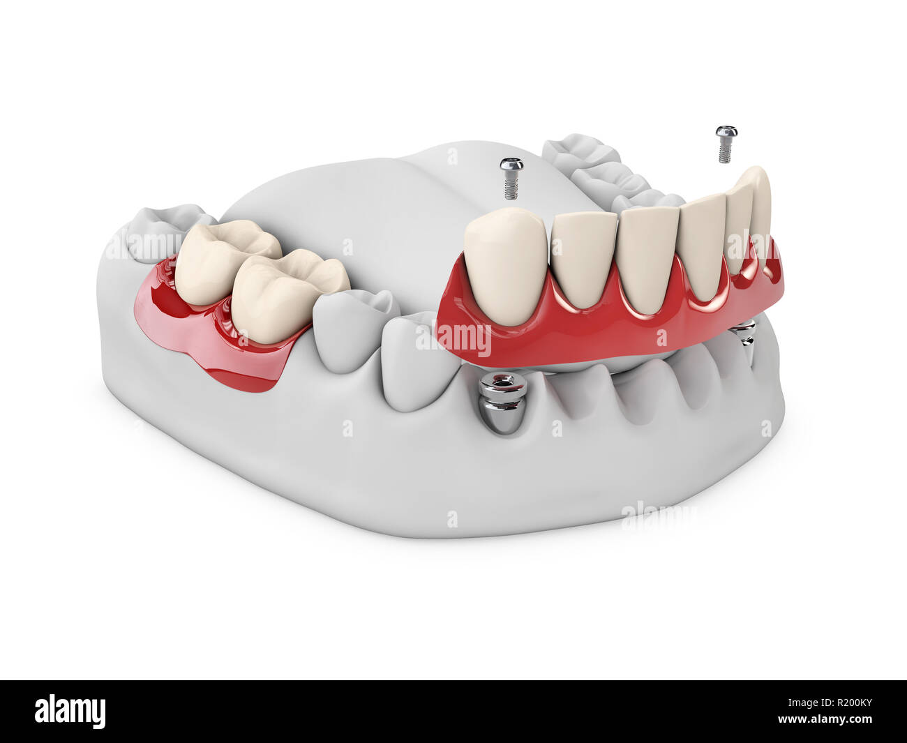 Anatomy of healthy teeth and dental implant in jaw bone. Stomatology