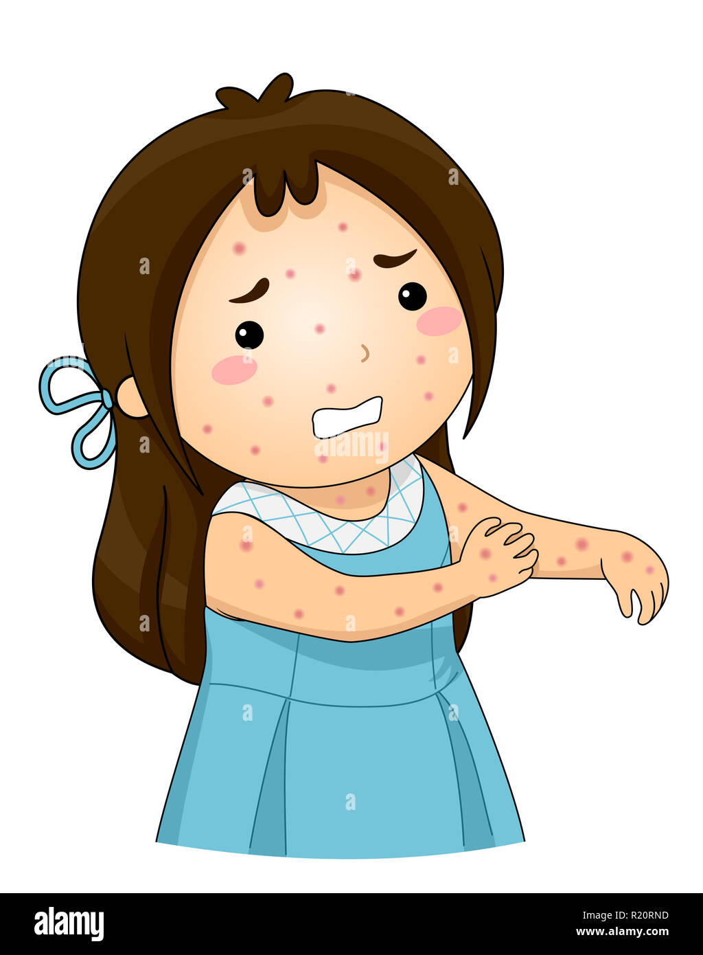 Illustration of a Kid Girl with Chickenpox Scratching her Itchy Skin Stock  Photo - Alamy