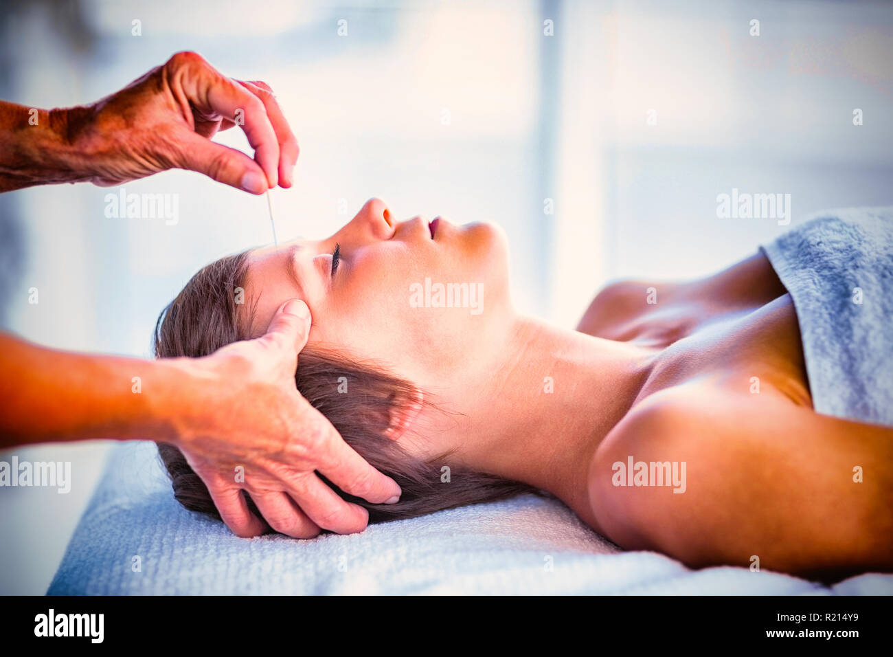 Woman receiving acupuncture treatment Stock Photo
