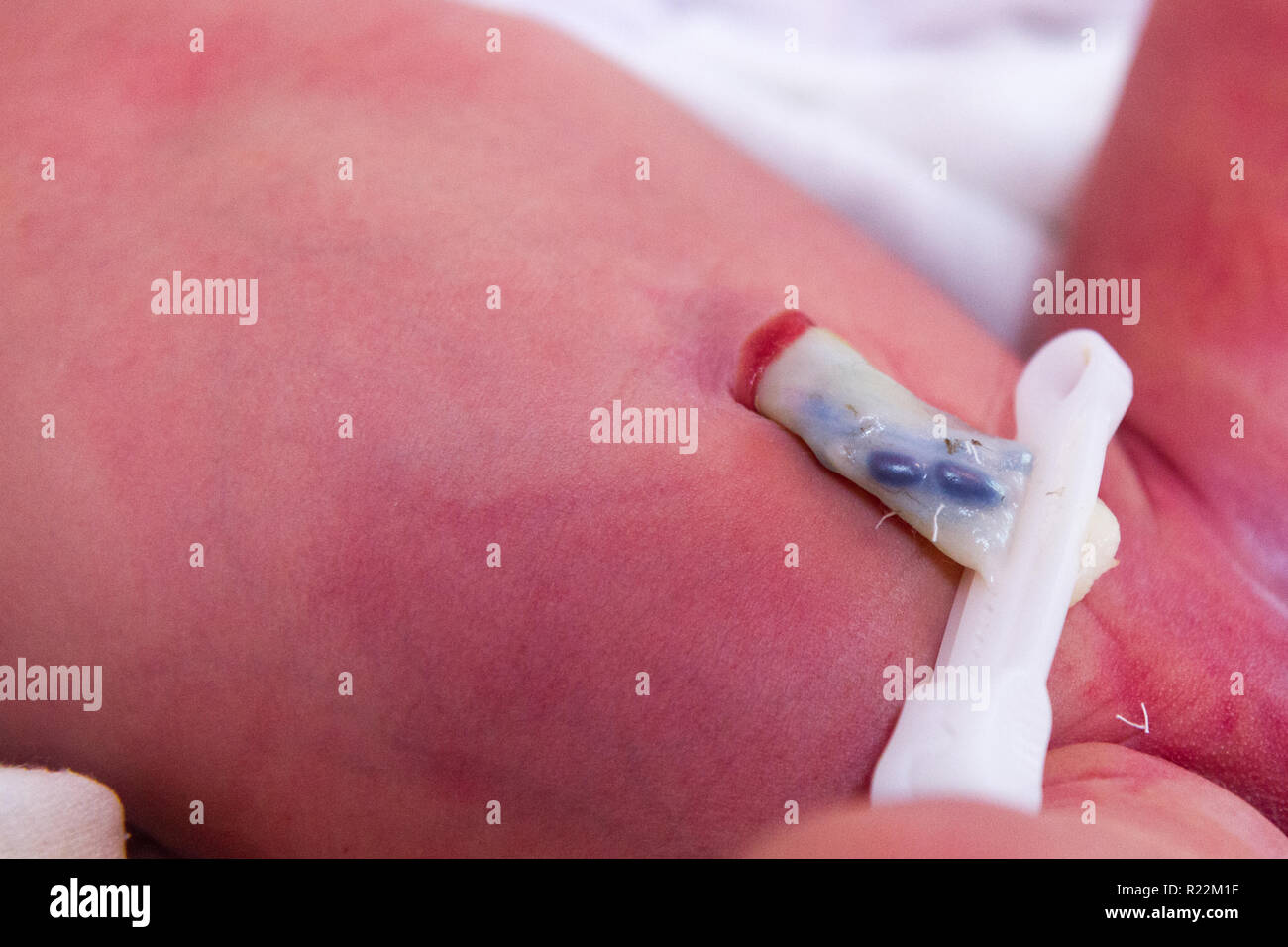 a clamped umbilical cord stump of a newborn baby Stock Photo