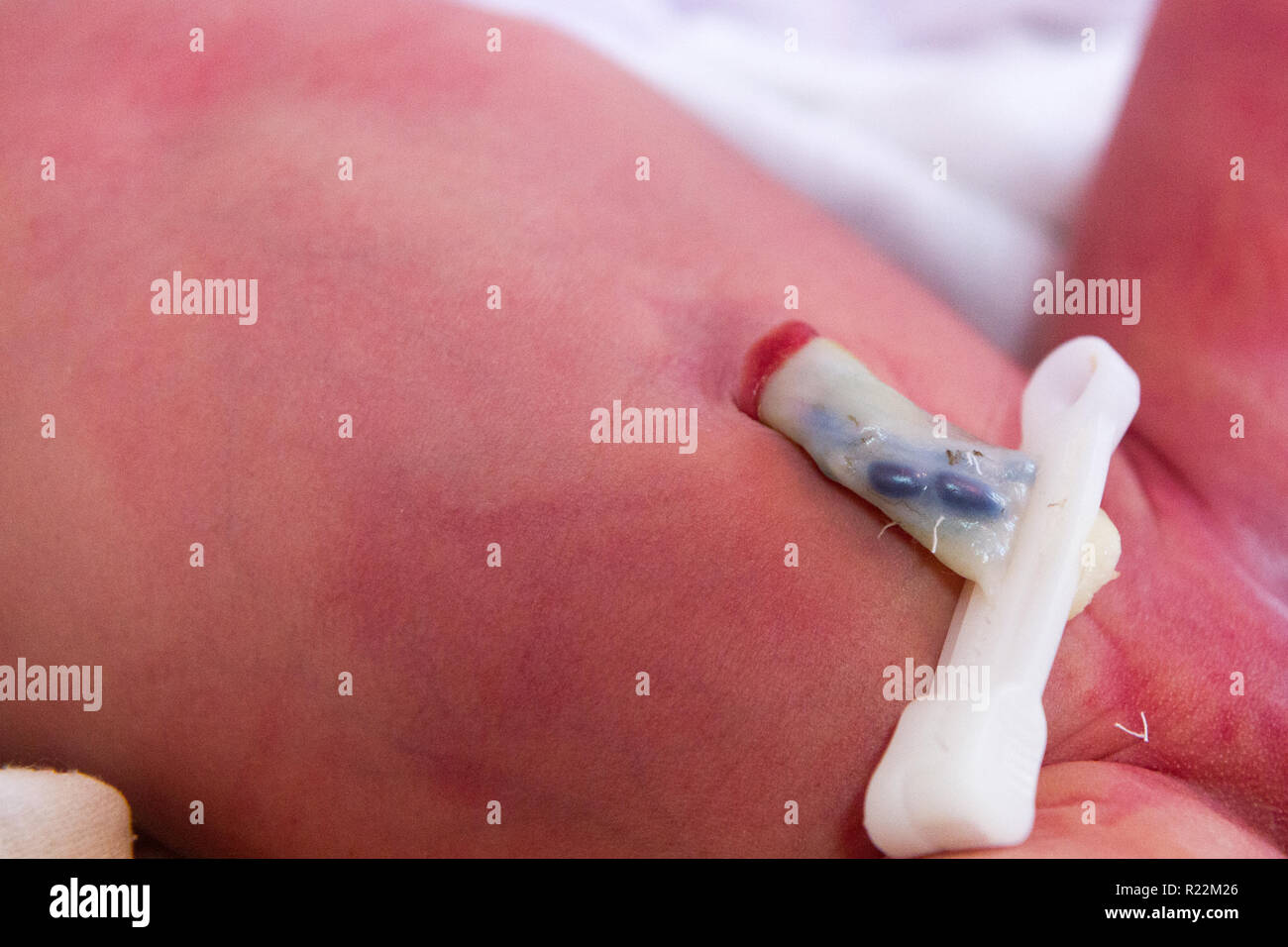 a clamped umbilical cord stump of a newborn baby Stock Photo