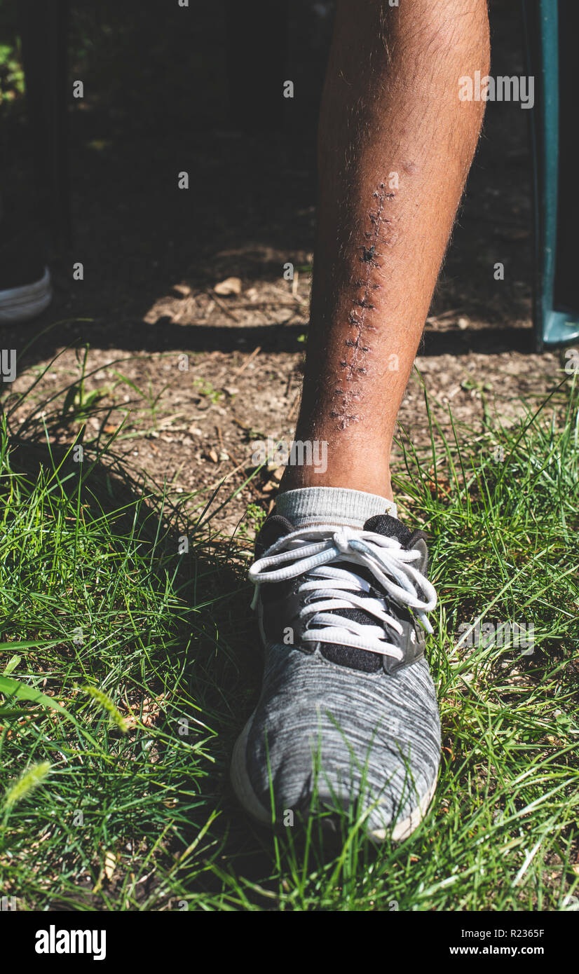 Stitch leg injury. Boy with sneakers Stock Photo