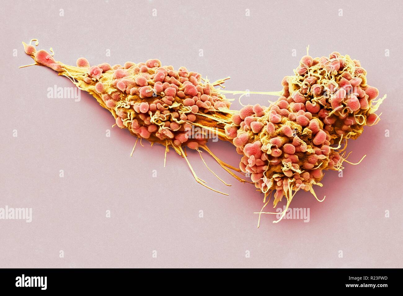 Ovarian cancer cells. Coloured scanning electron micrograph (SEM) of ovarian cancer cells. Cancer cells are typically large, have an irregular surface Stock Photo