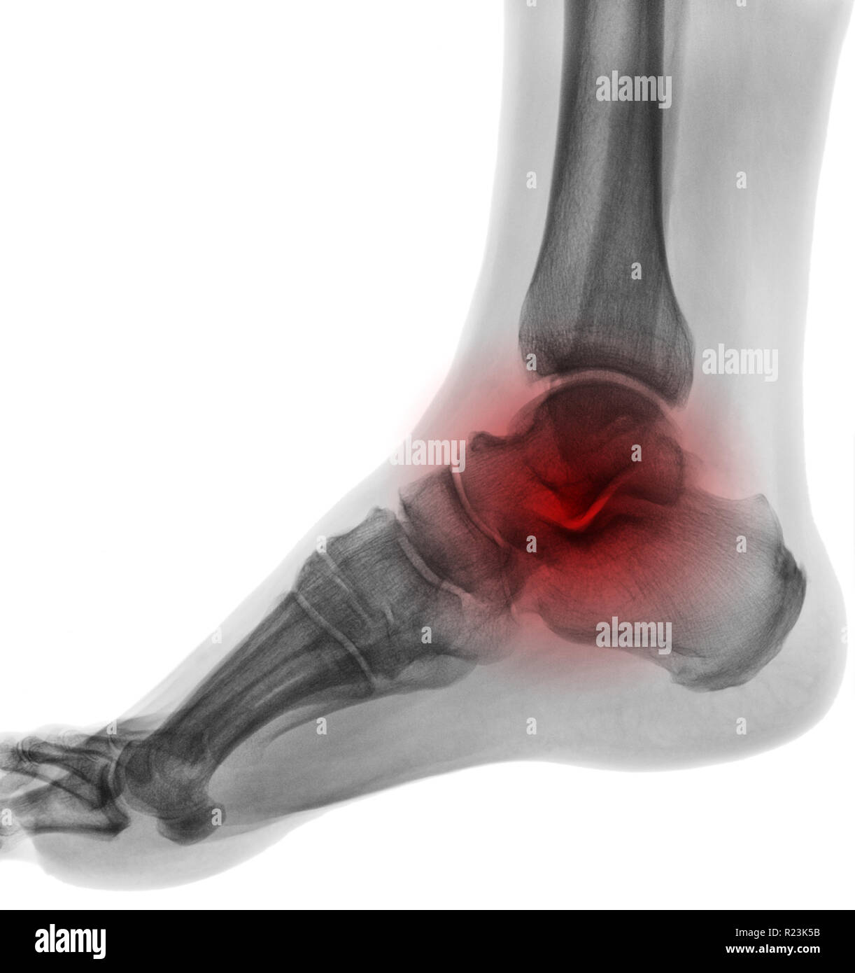 X-ray medical picture - Human knee with red symbol of painful place Stock Photo