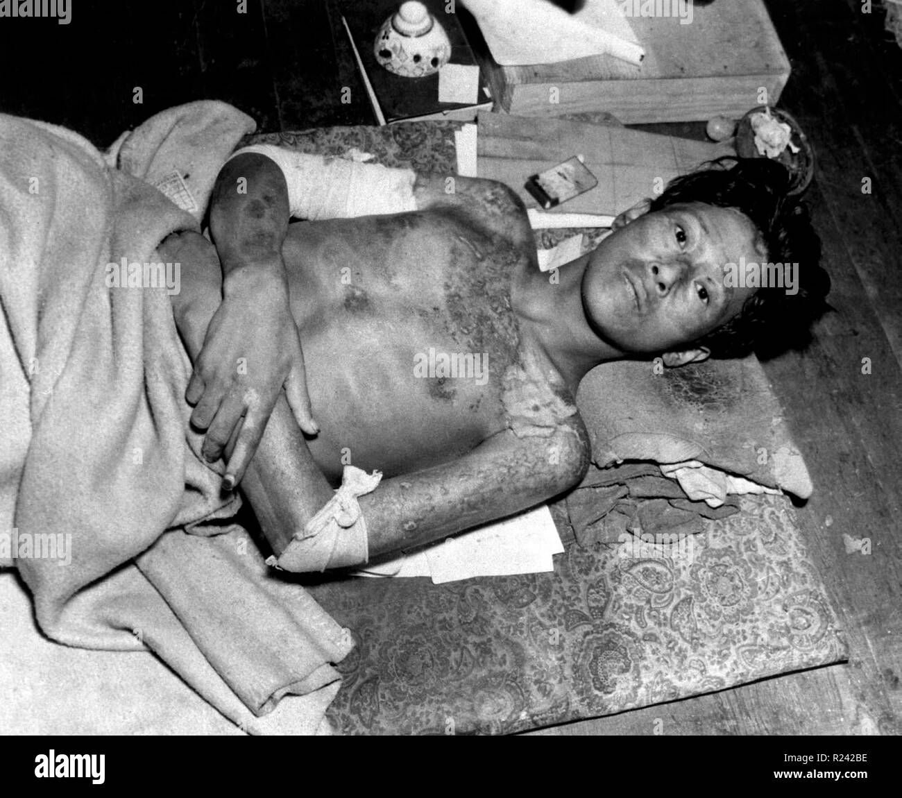 World War II, casualty after the explosion of the atom bomb in August 1945 Hiroshima, Japan Stock Photo