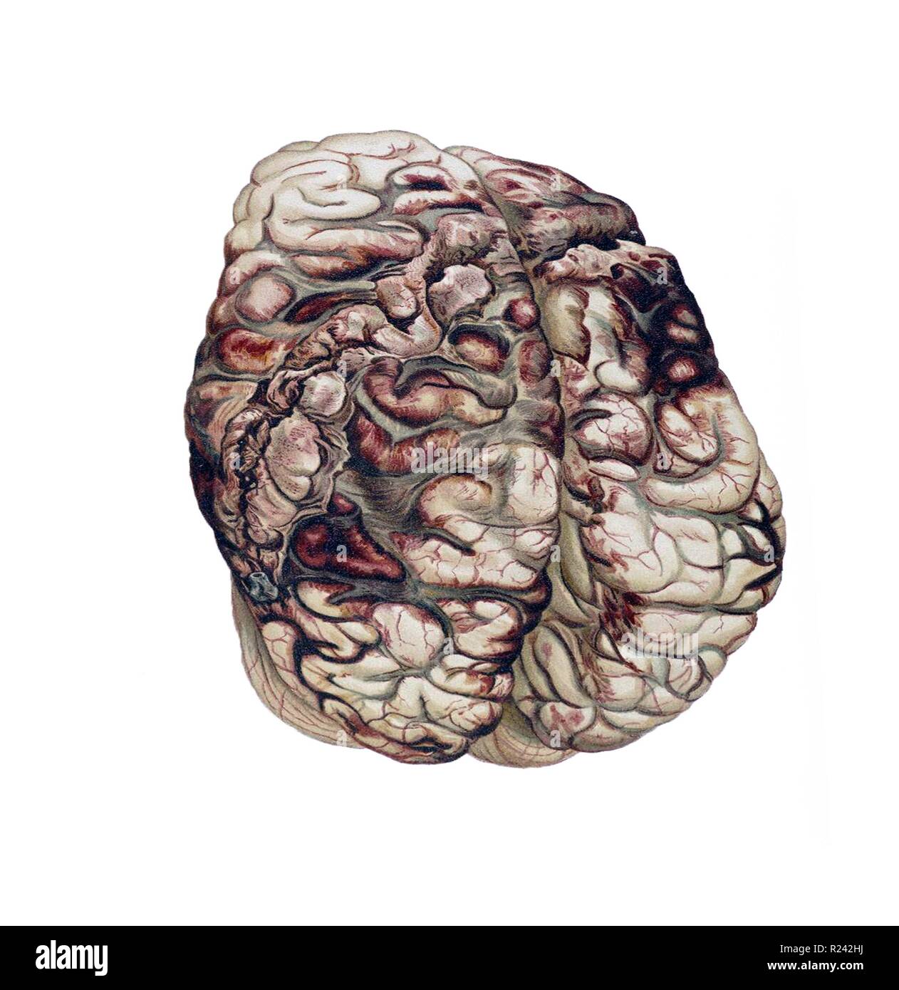 Encircling Gunshot-wound in the Brain, 1898 In atlases and manuals of legal medicine, 19th-century forensic pathologists used pictures and words to show students and colleagues their methodology Stock Photo