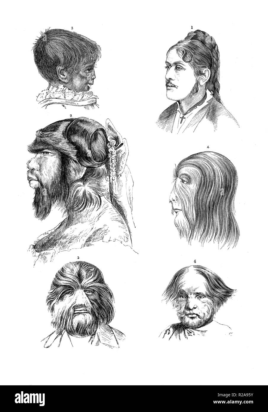 Vintage illustration of anatomy, human  male and female heads with trichosis, hairiness disease Stock Photo