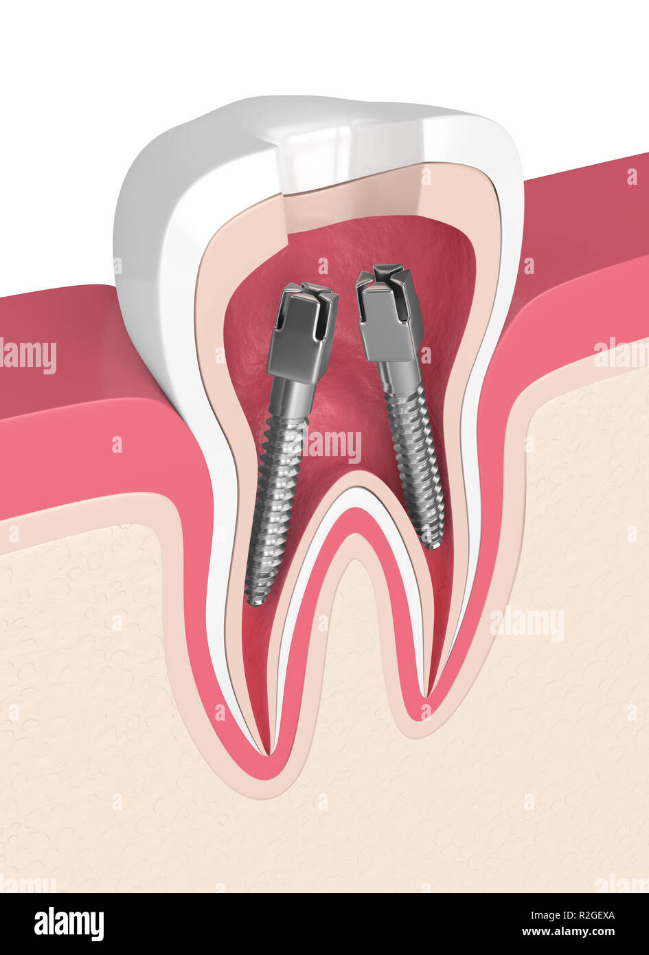 3d render of tooth in gums with dental root canal posts Stock Photo