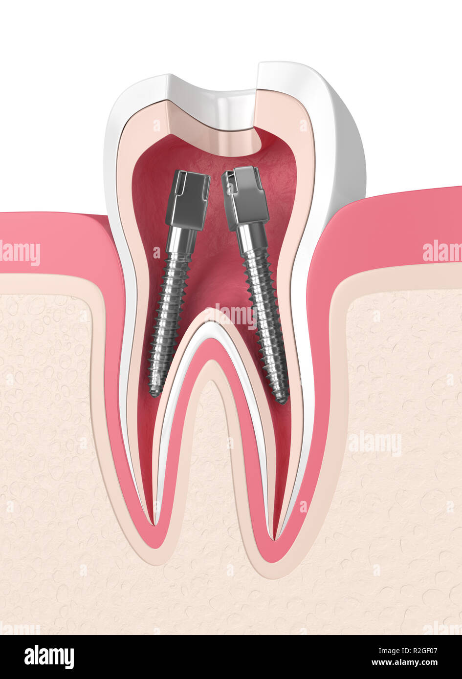 3d render of tooth in gums with dental root canal posts Stock Photo