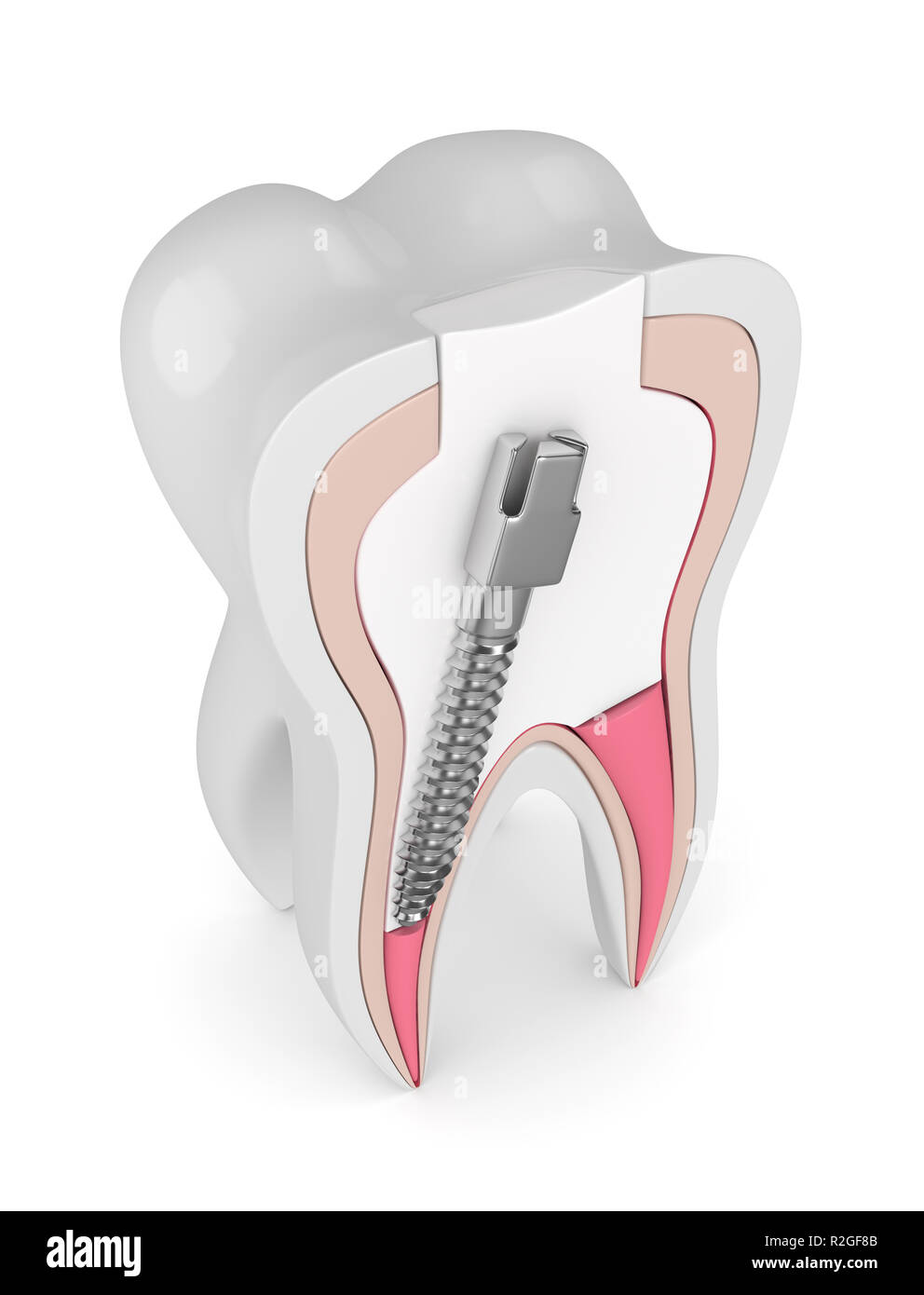 3d render of tooth with gutta percha, post and filling over white
