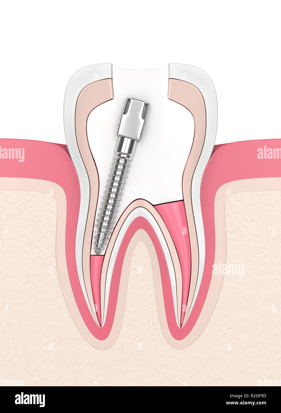 3d render of tooth with gutta percha, post and filling in gums