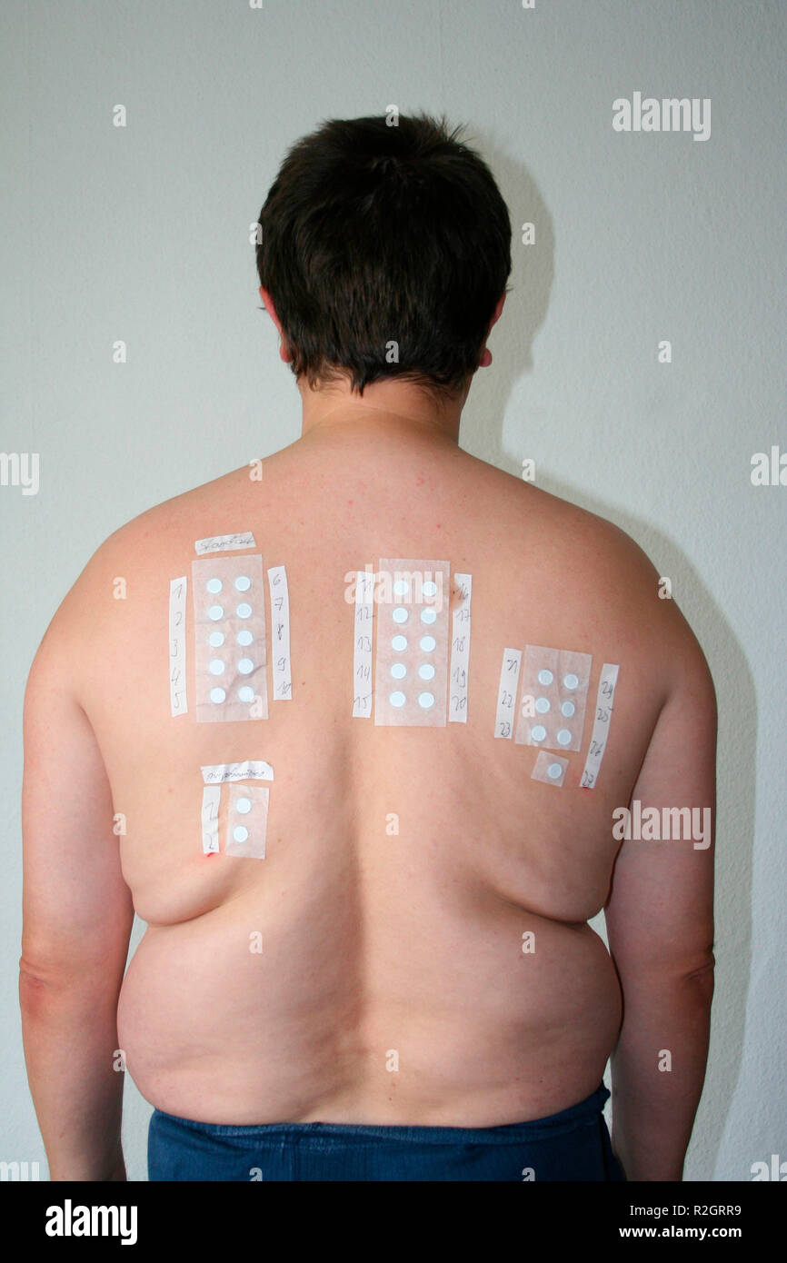 patch test allergy test Stock Photo