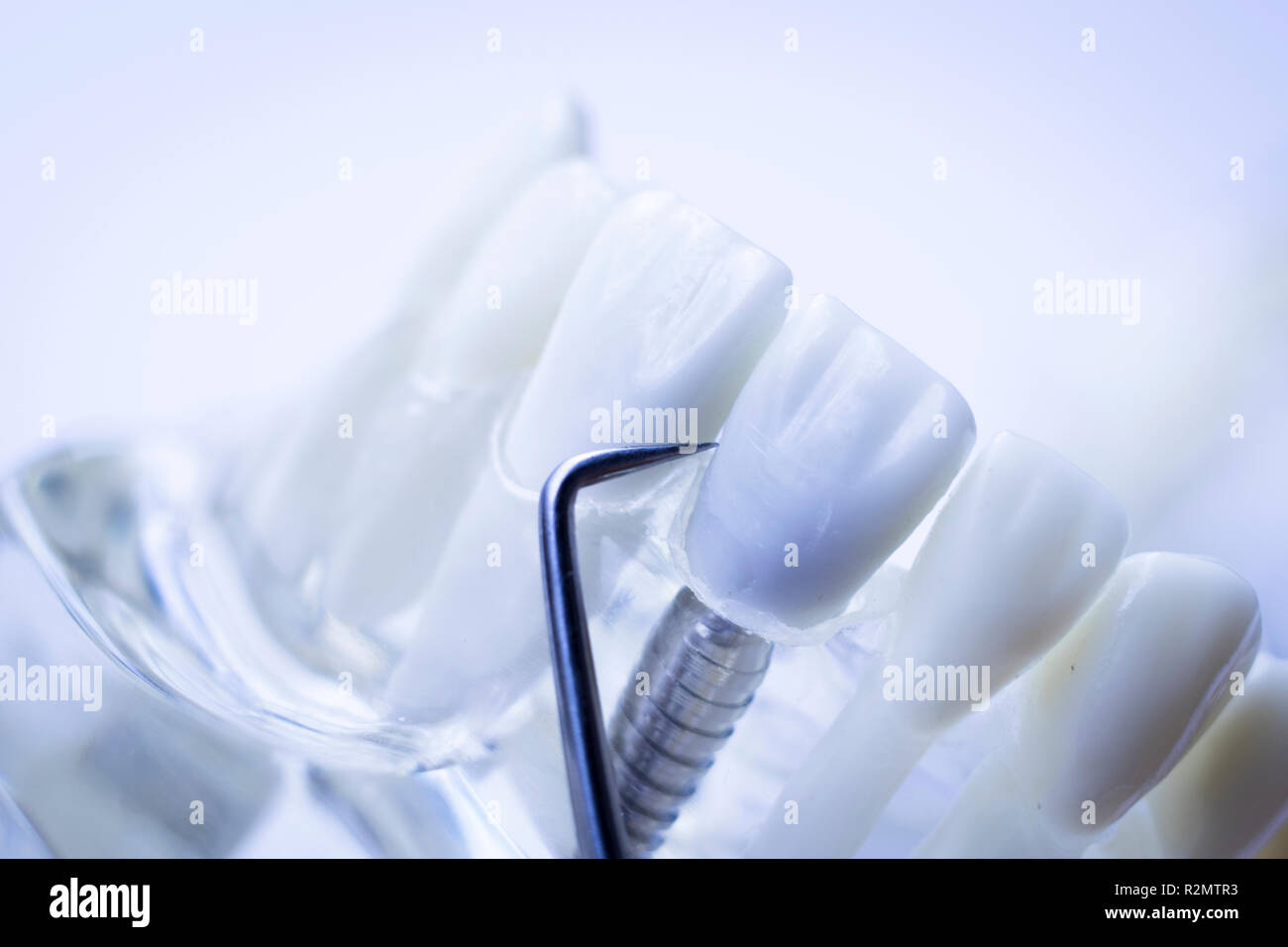 Dentist cleaning teeth with titanium metal tooth pick instrument to