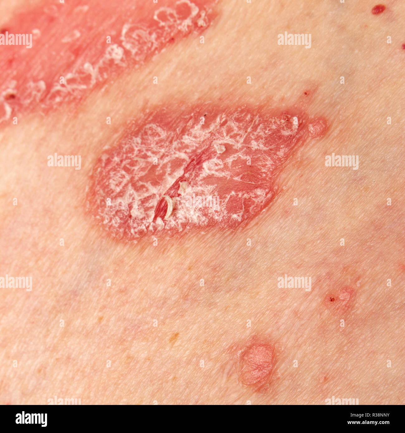 Chronic Autoimmune Disease High Resolution Stock Photography and Images