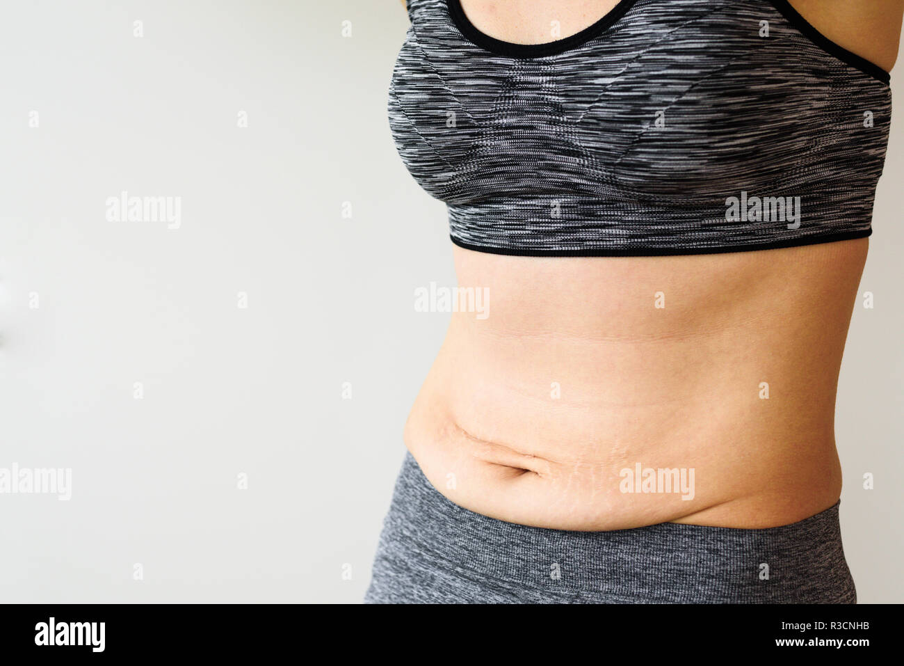 Woman belly after dieting. Skinny fat concept. Stretch marks Stock Photo -  Alamy