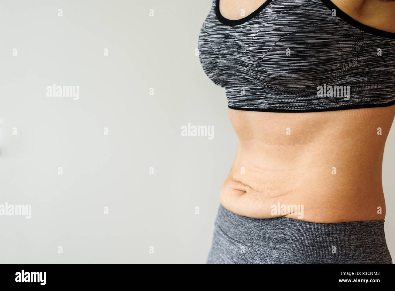 Woman belly after dieting. Skinny fat concept. Stretch marks Stock Photo