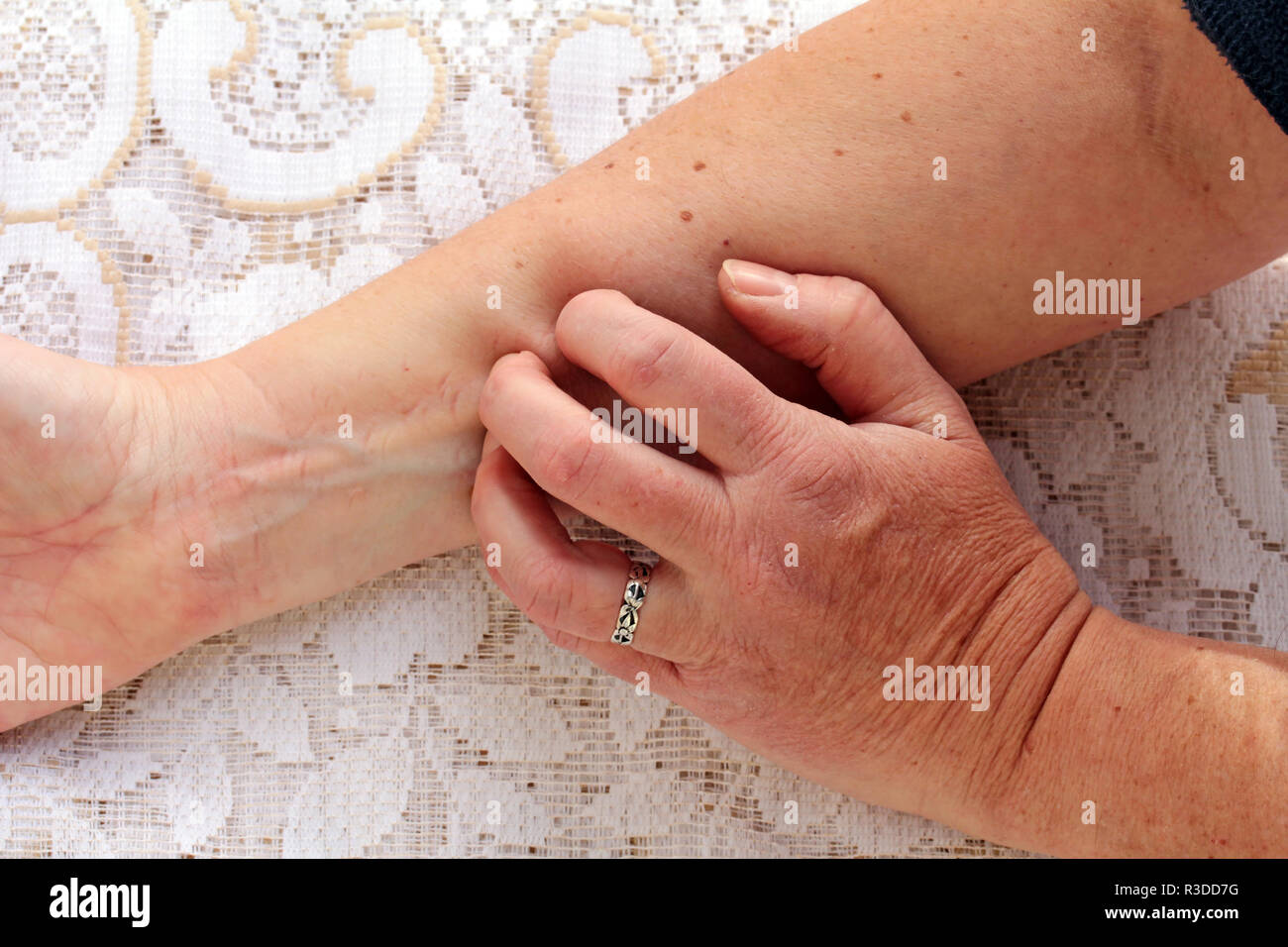 dry itchy skin Stock Photo