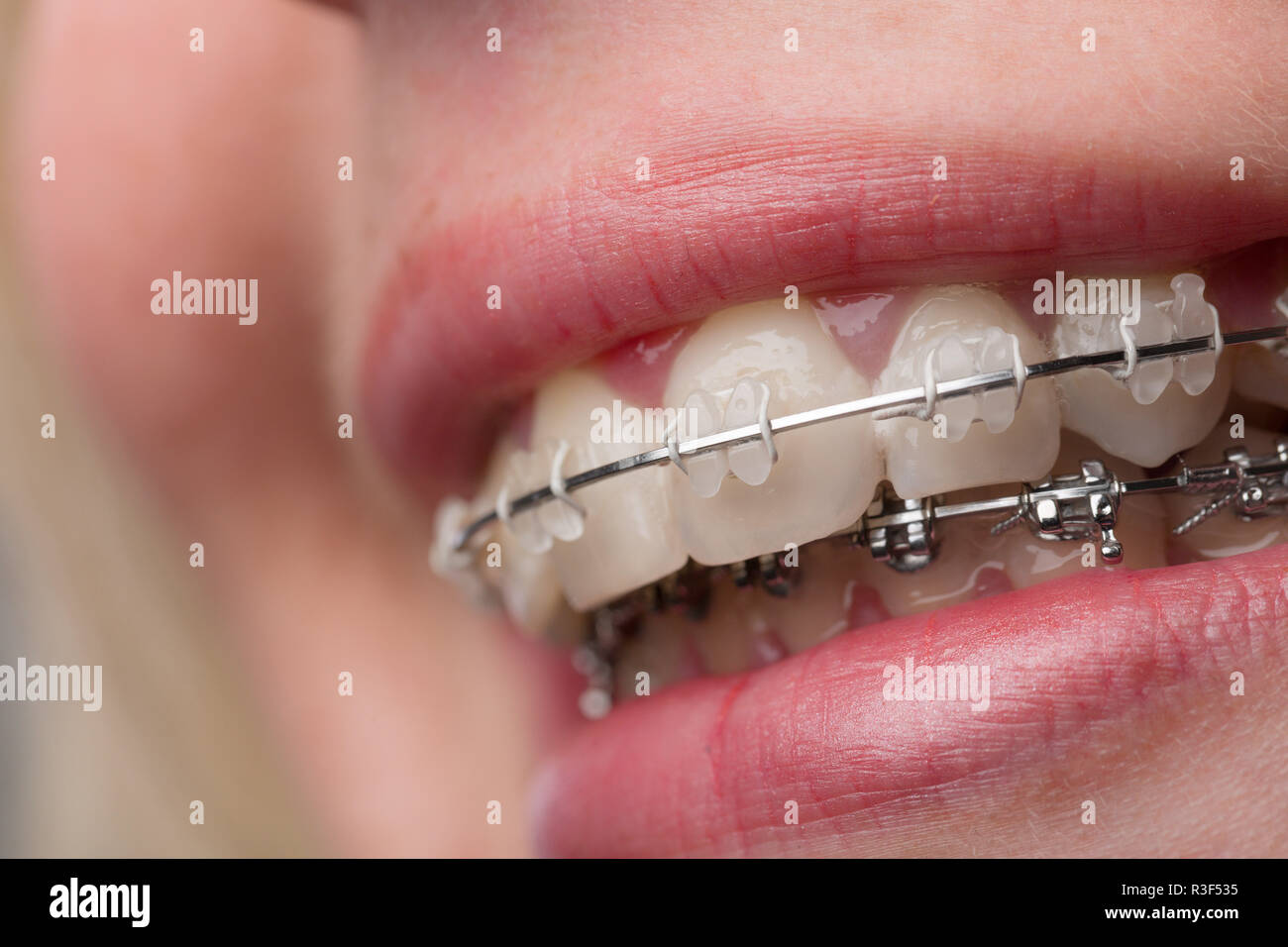 mouth with braces Stock Photo Alamy