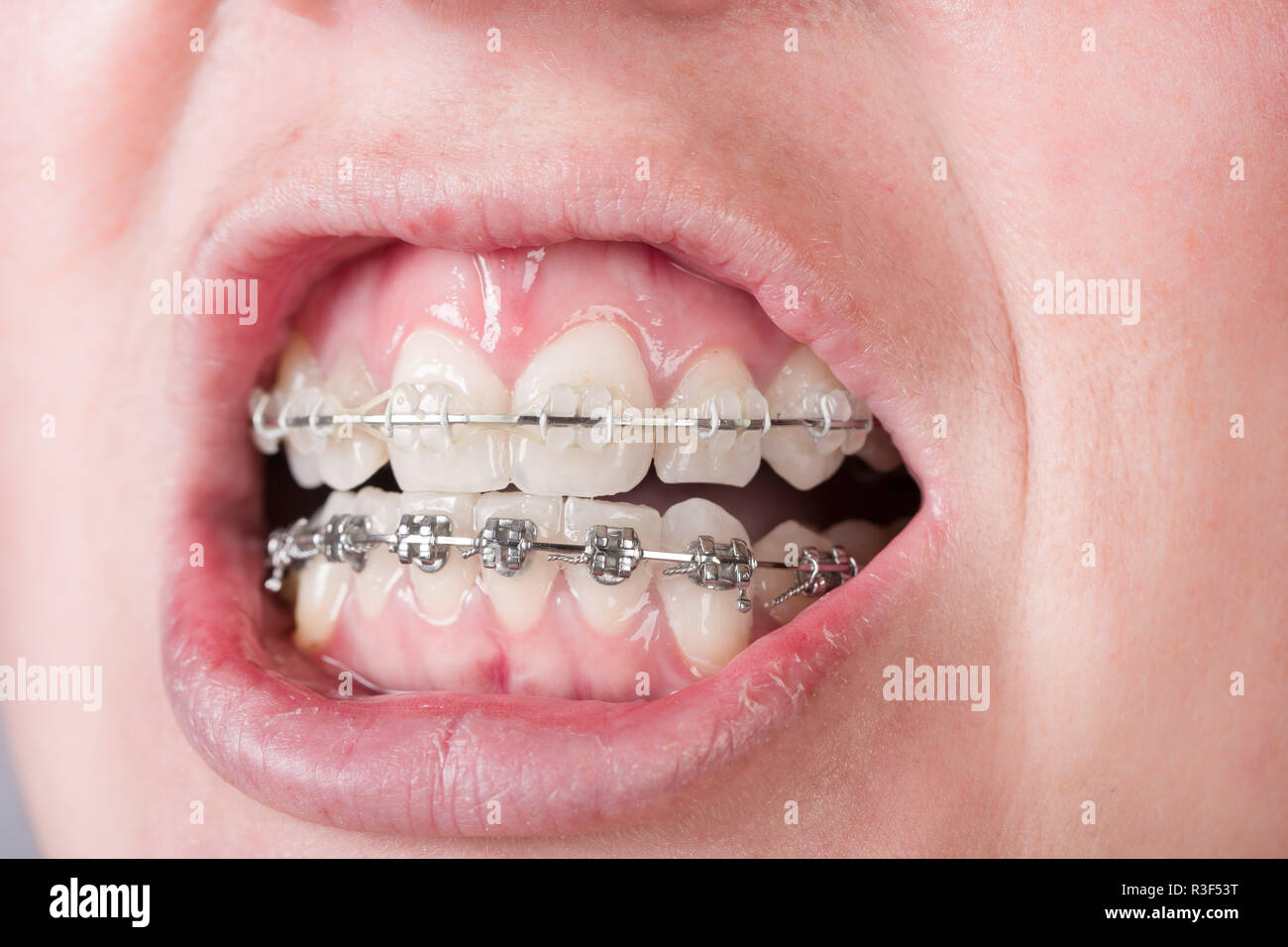 mouth with braces Stock Photo Alamy