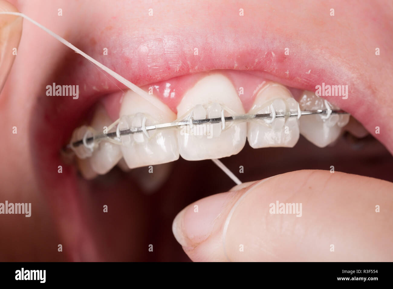 mouth with braces Stock Photo Alamy