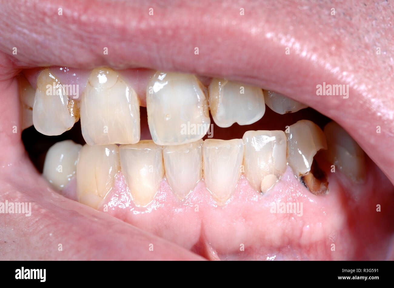 bad teeth Stock Photo Alamy