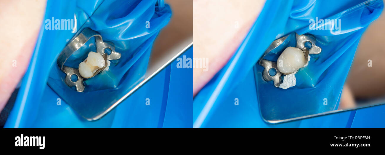 Teeth during treatment closeup in a dental clinic. Dental photopolymer