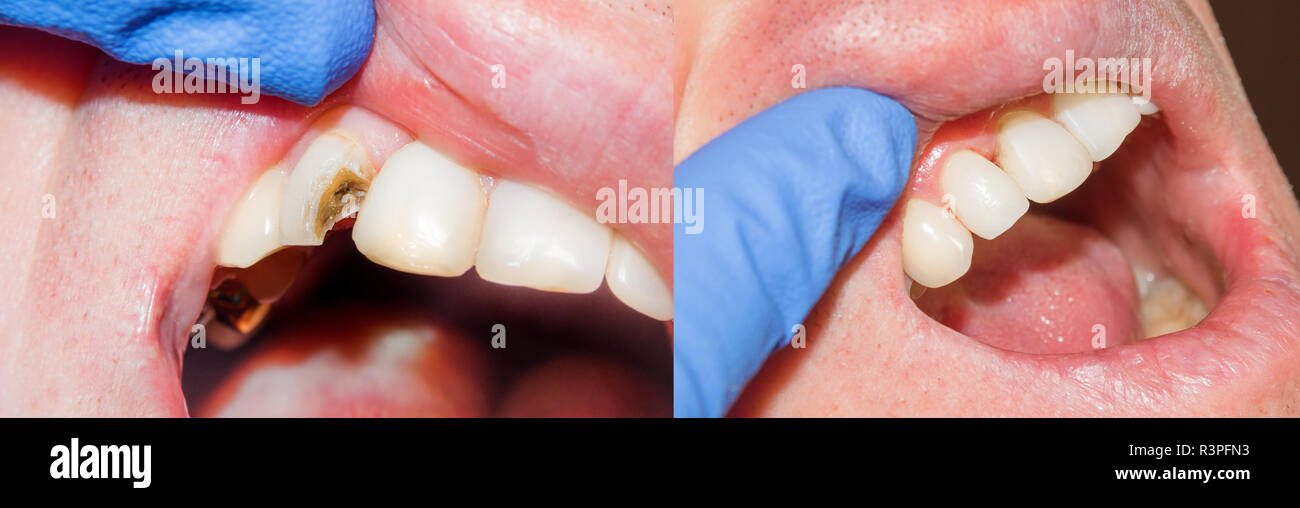 Teeth during treatment closeup in a dental clinic. Dental photopolymer