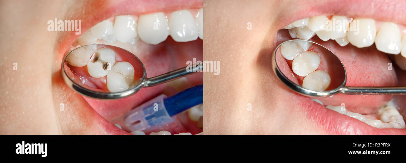 Teeth during treatment closeup in a dental clinic. Dental photopolymer