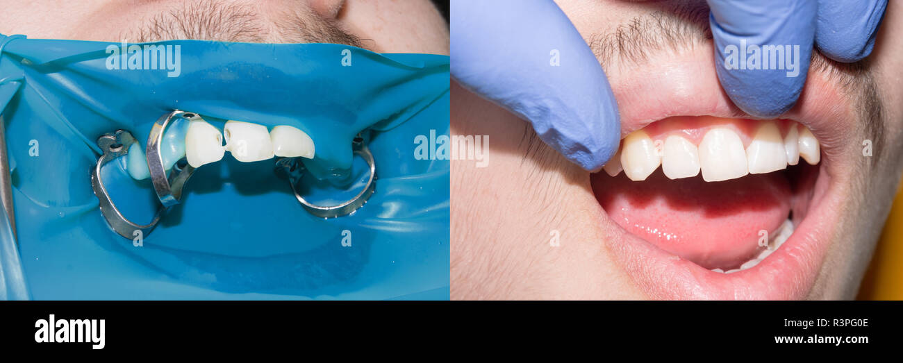 Teeth during treatment closeup in a dental clinic. Dental photopolymer