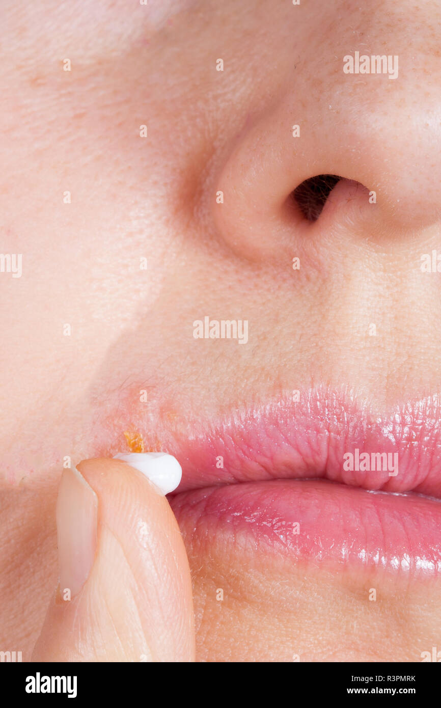 Herpes on the lip close-up macro. Woman lubricates the labial herpes ointment Stock Photo